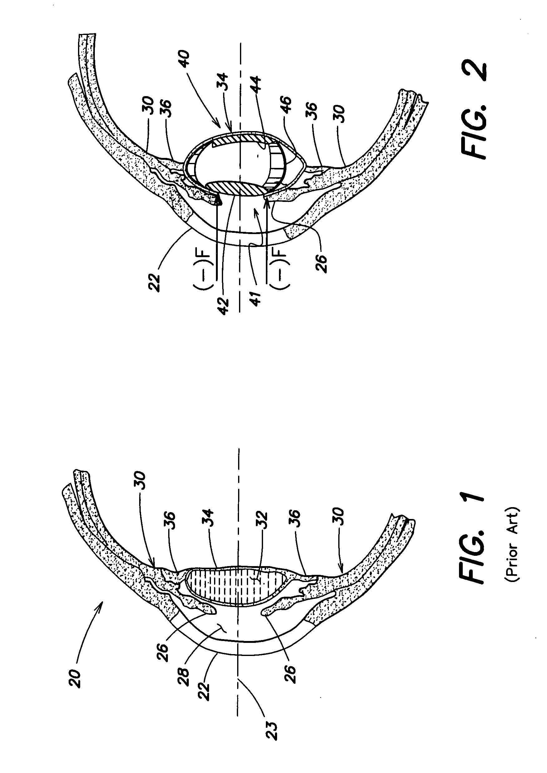 Accommodative Intraocular Lens Having Defined Axial Compression Characteristics