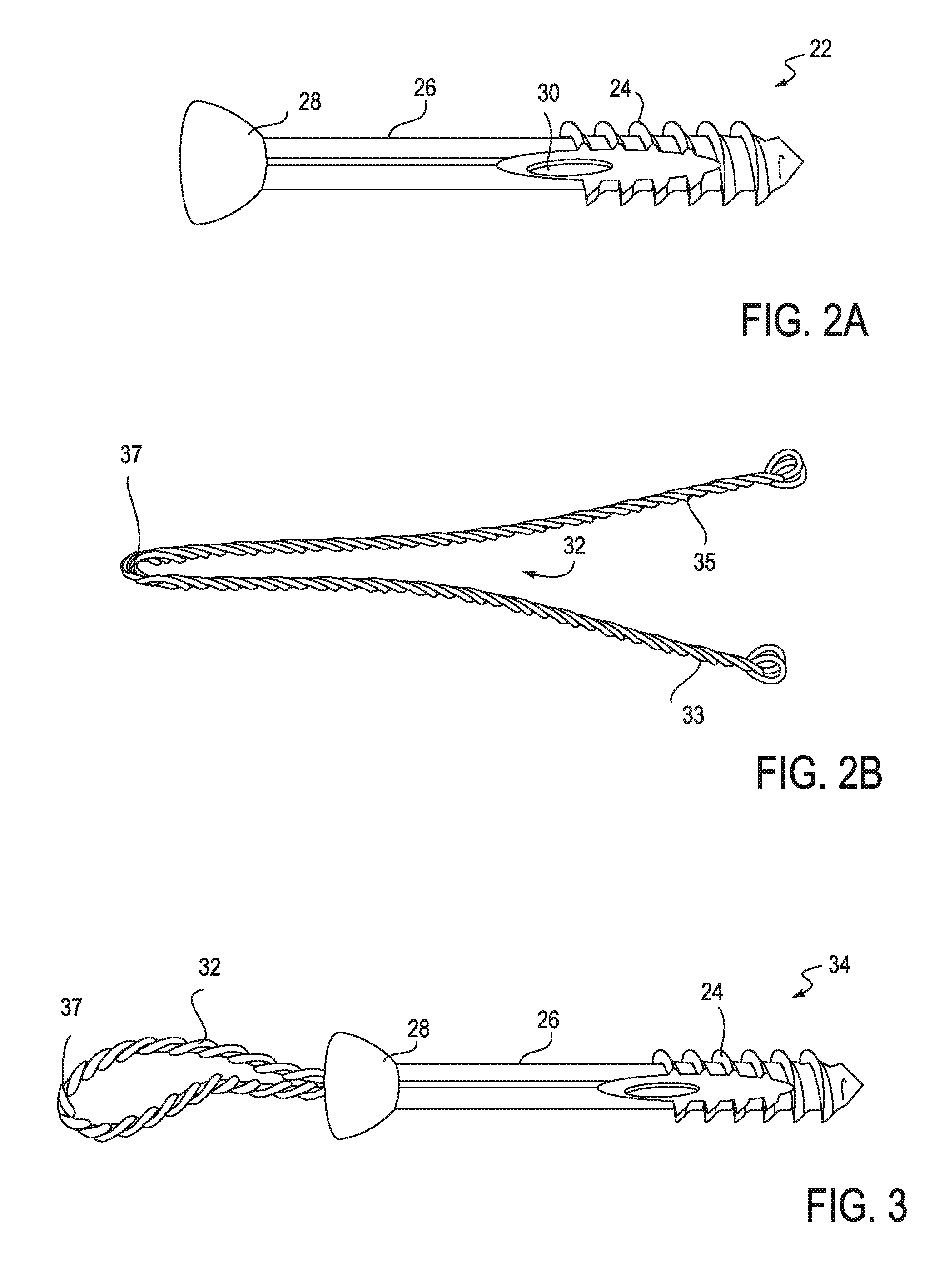 Bone implant and systems that controllably releases silver