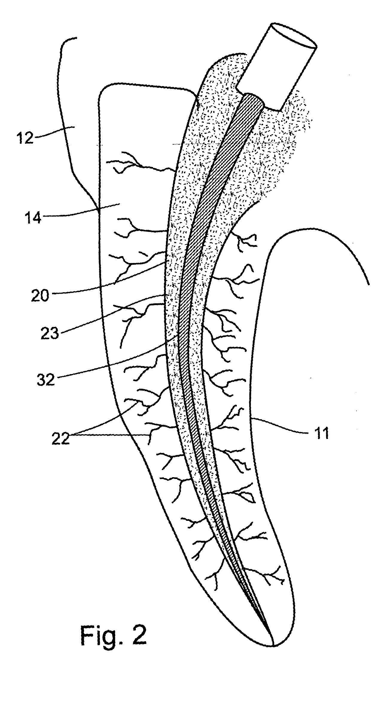 Device, method and materials for mobilizing substances into dentinal tubules in root canal treatment