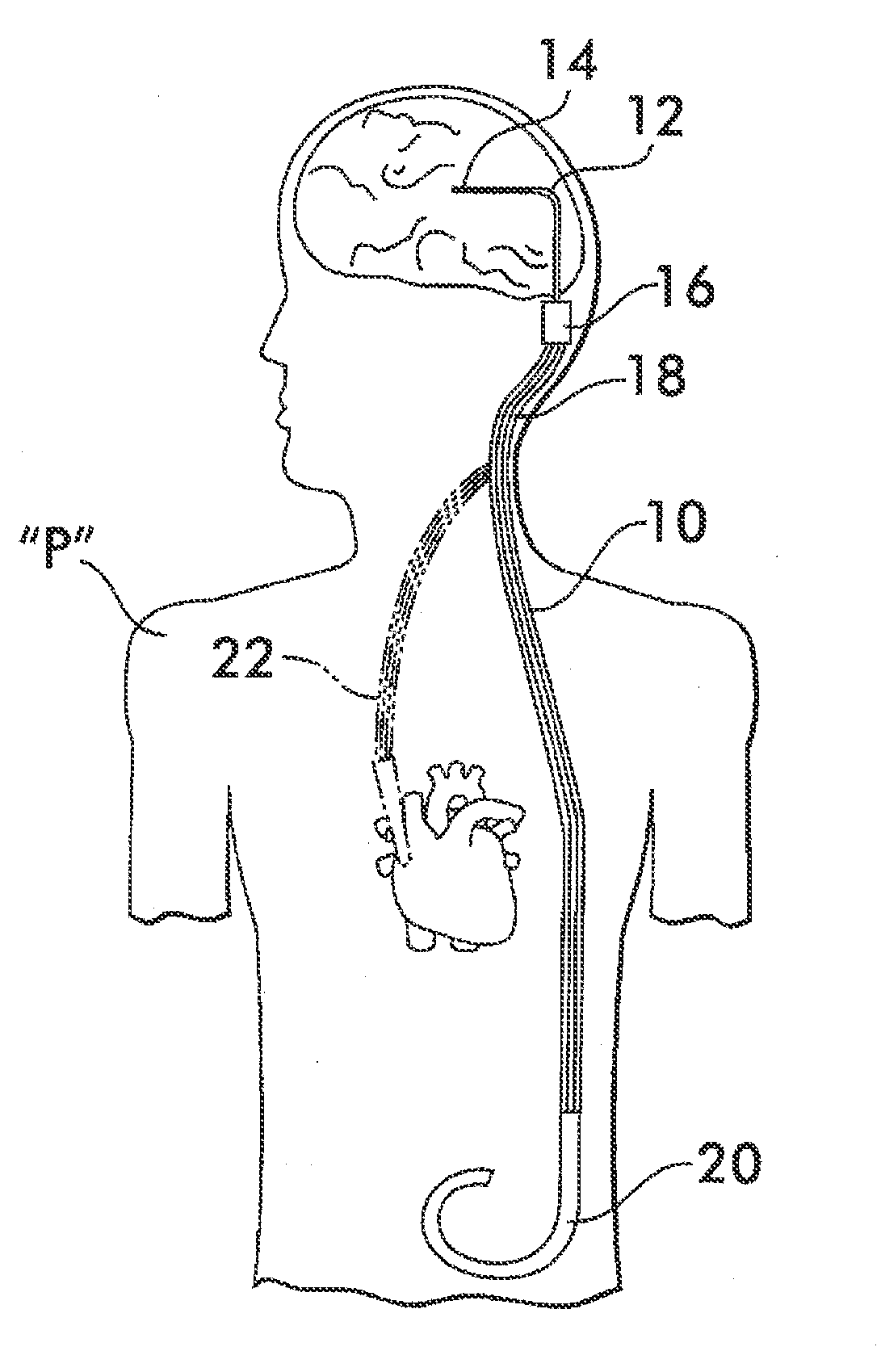 Implantable shunt or catheter enabling gradual delivery of therapeutic agents