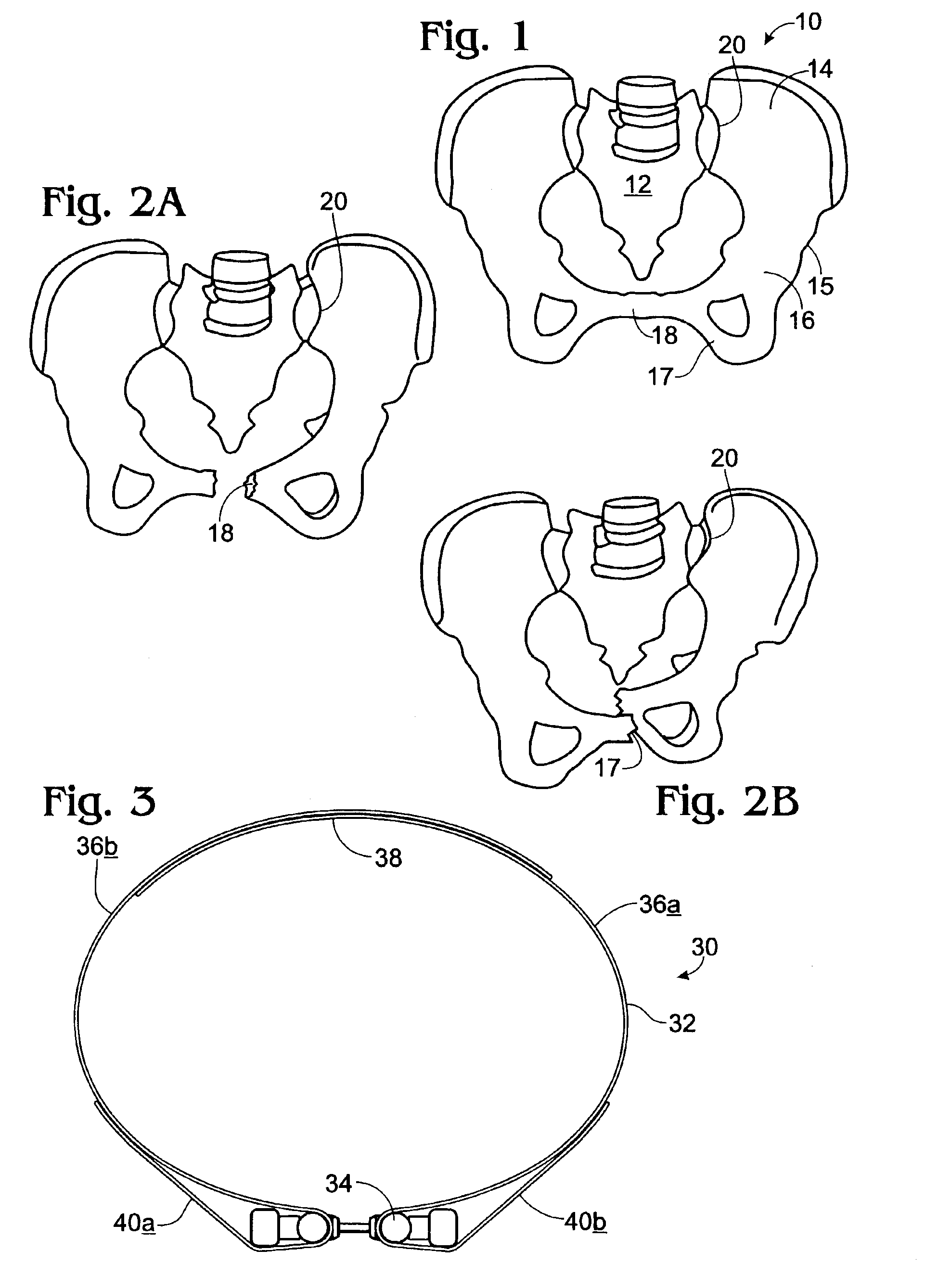 Apparatus and method for stabilizing pelvic ring disruption