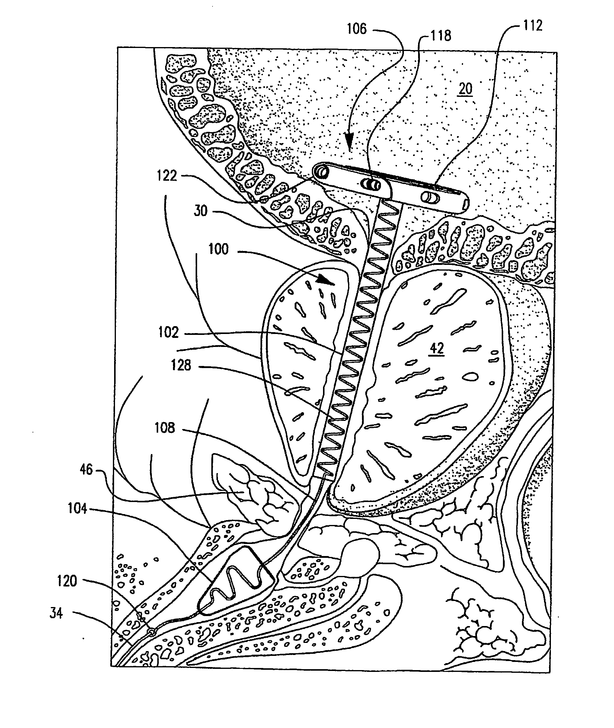 Self-adjusting endourethral device & methods of use