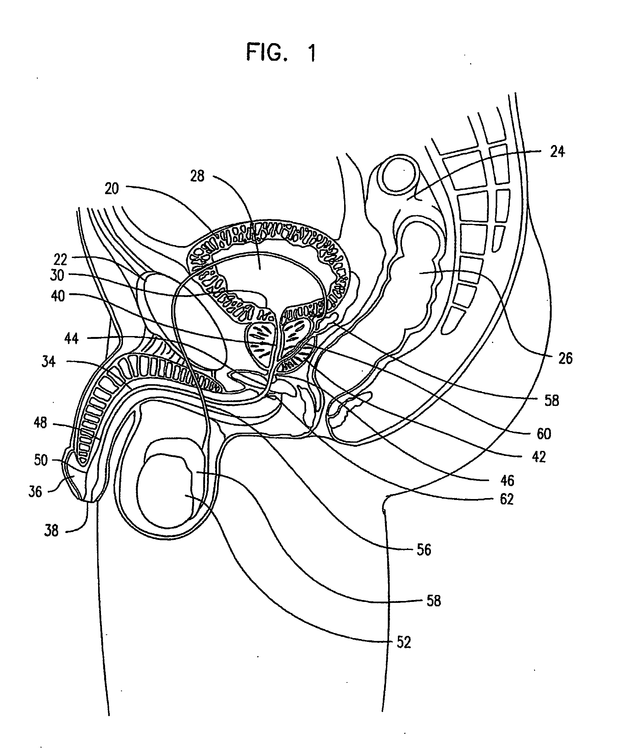 Self-adjusting endourethral device & methods of use