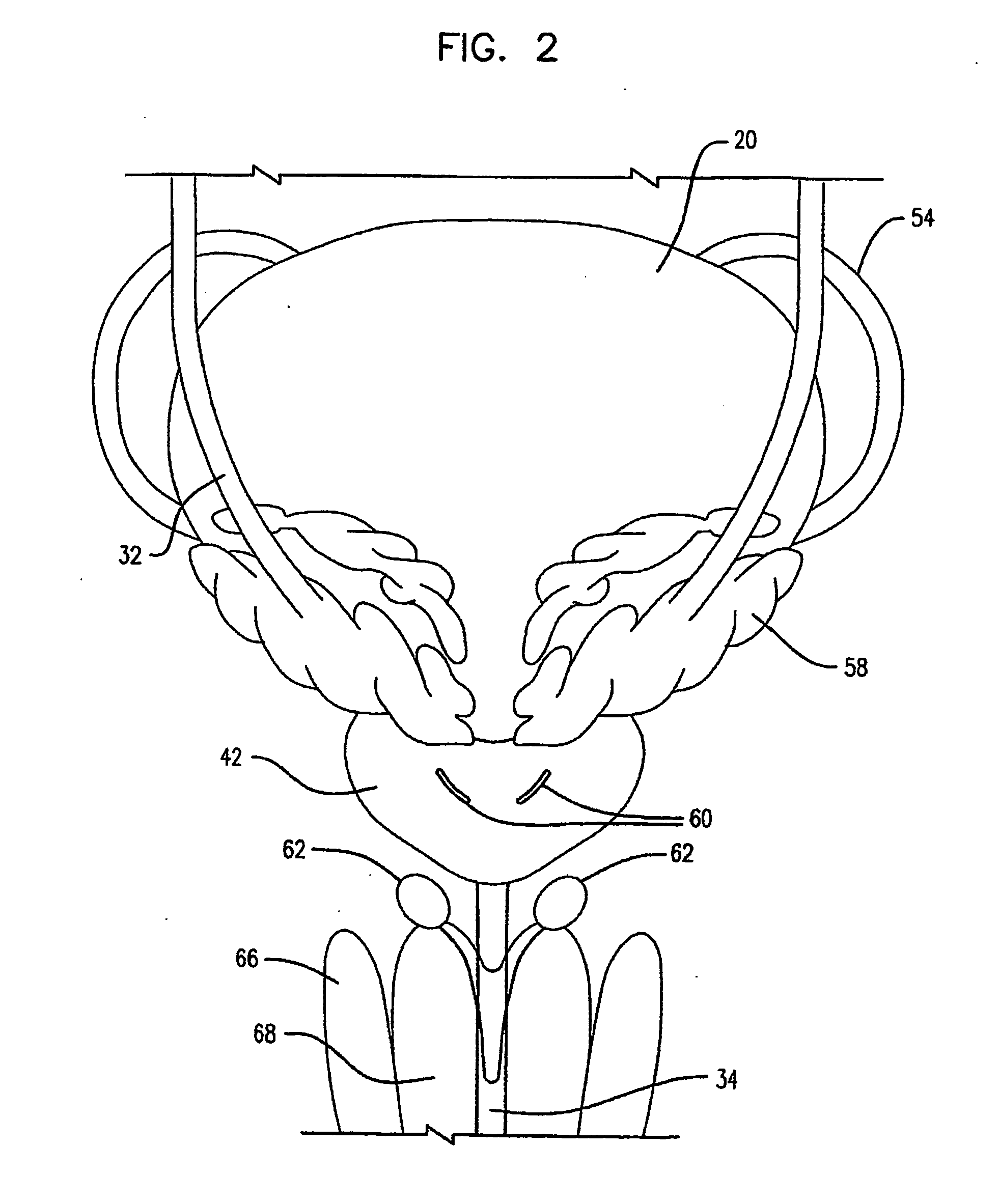 Self-adjusting endourethral device & methods of use