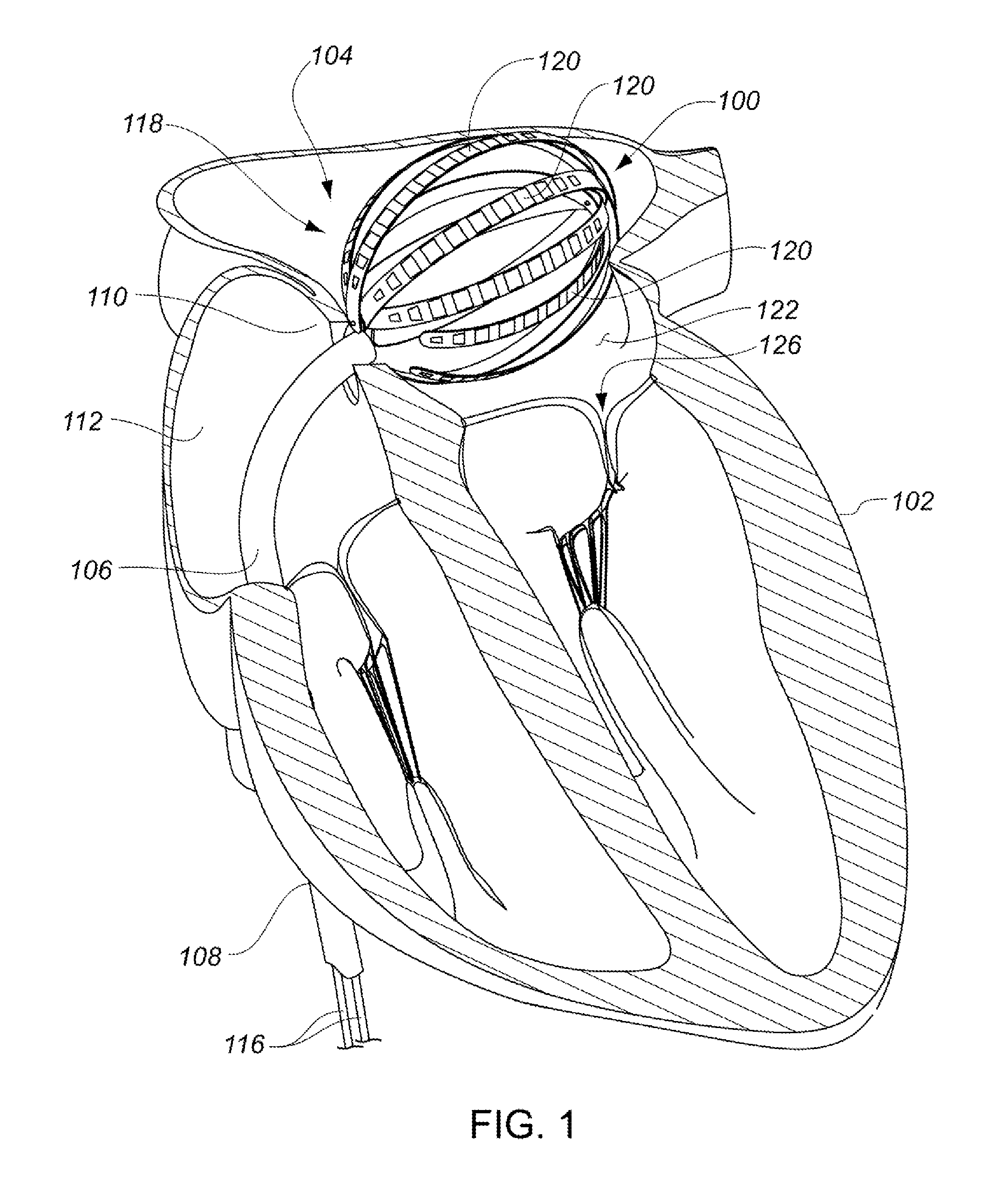 Enhanced medical device for use in bodily cavities, for example an atrium