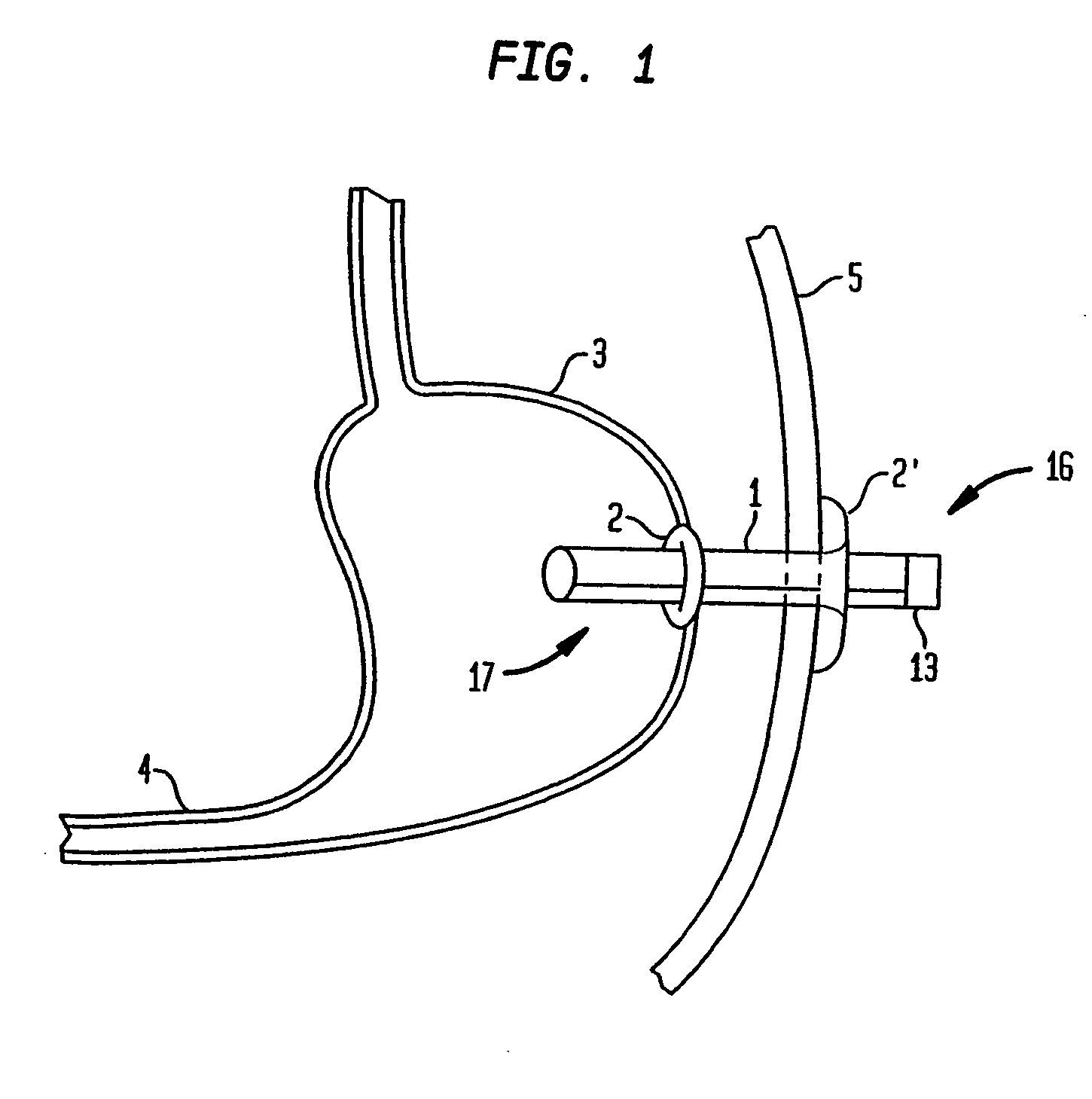 Apparatus for treating obesity by extracting food