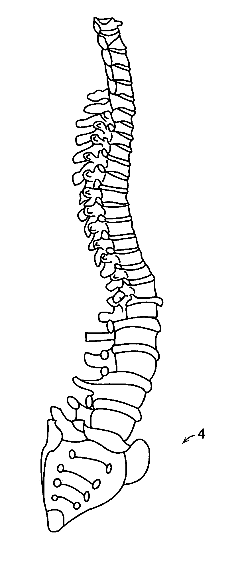 Method of deriving a quantitative measure of a degree of calcification of an aorta