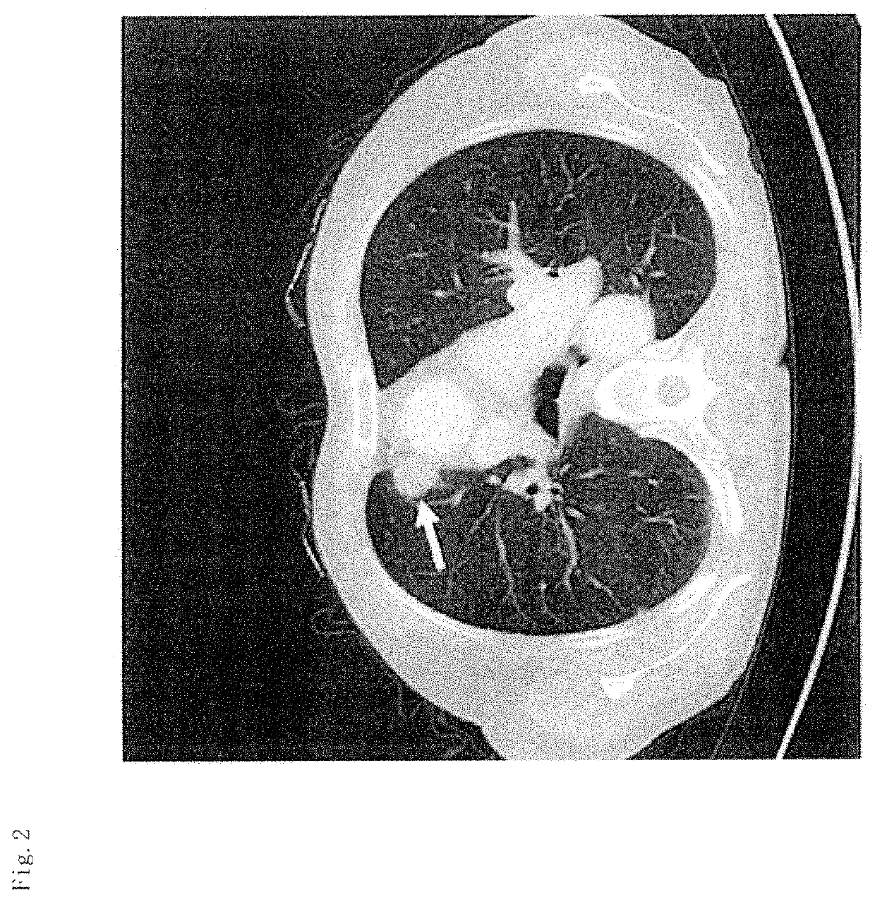 Adenocarcinoma detection method