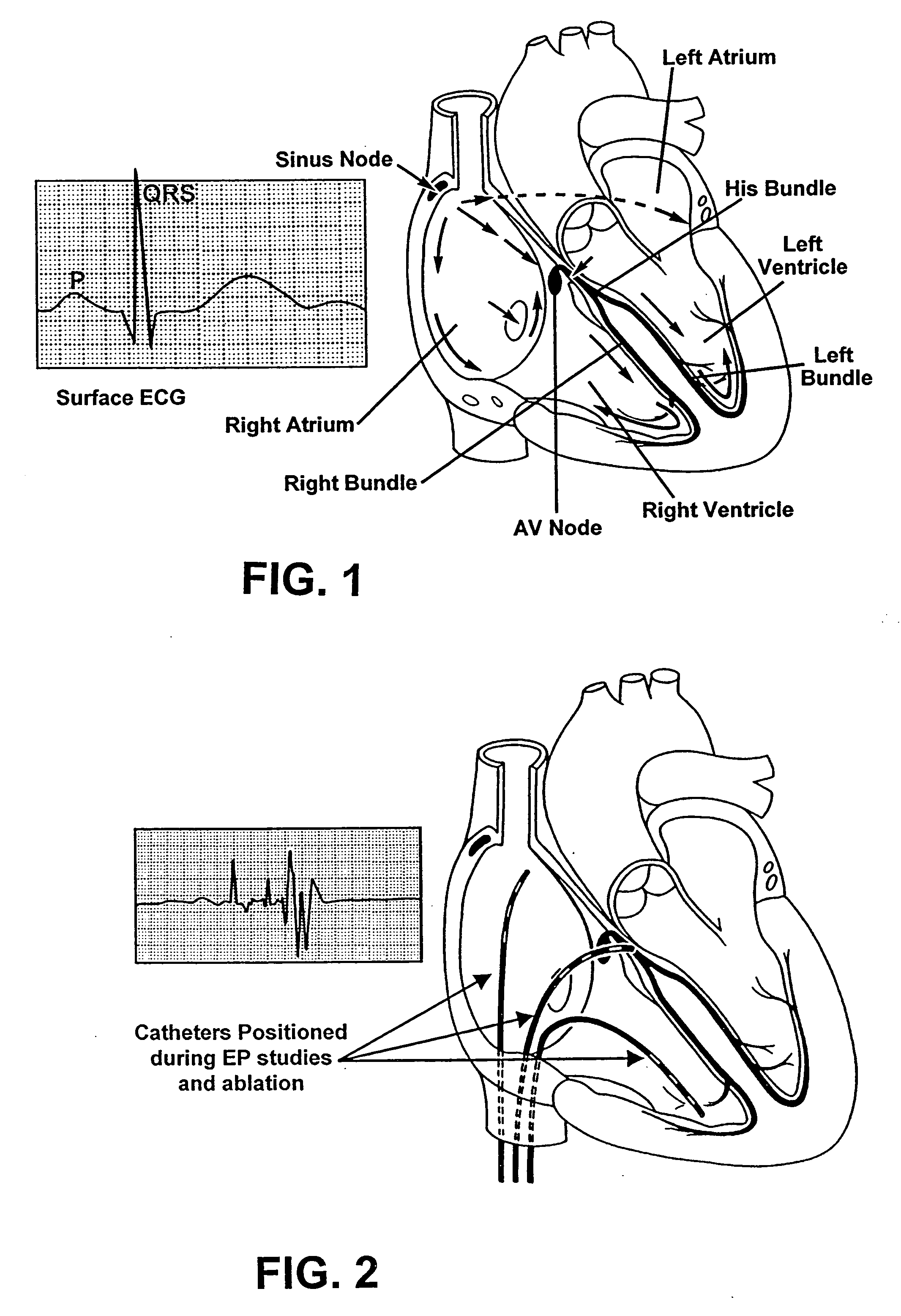 Catheter apparatus for treatment of heart arrhythmia