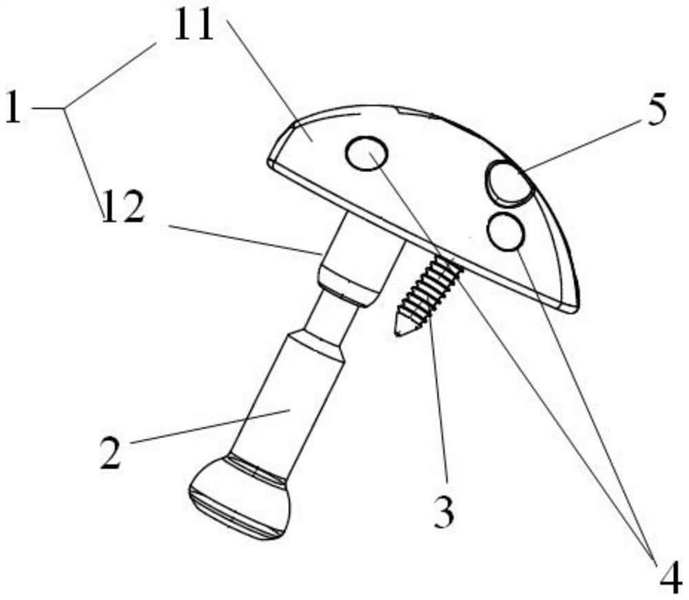 Ulna coronal process prosthesis device and mounting machine and mounting method thereof