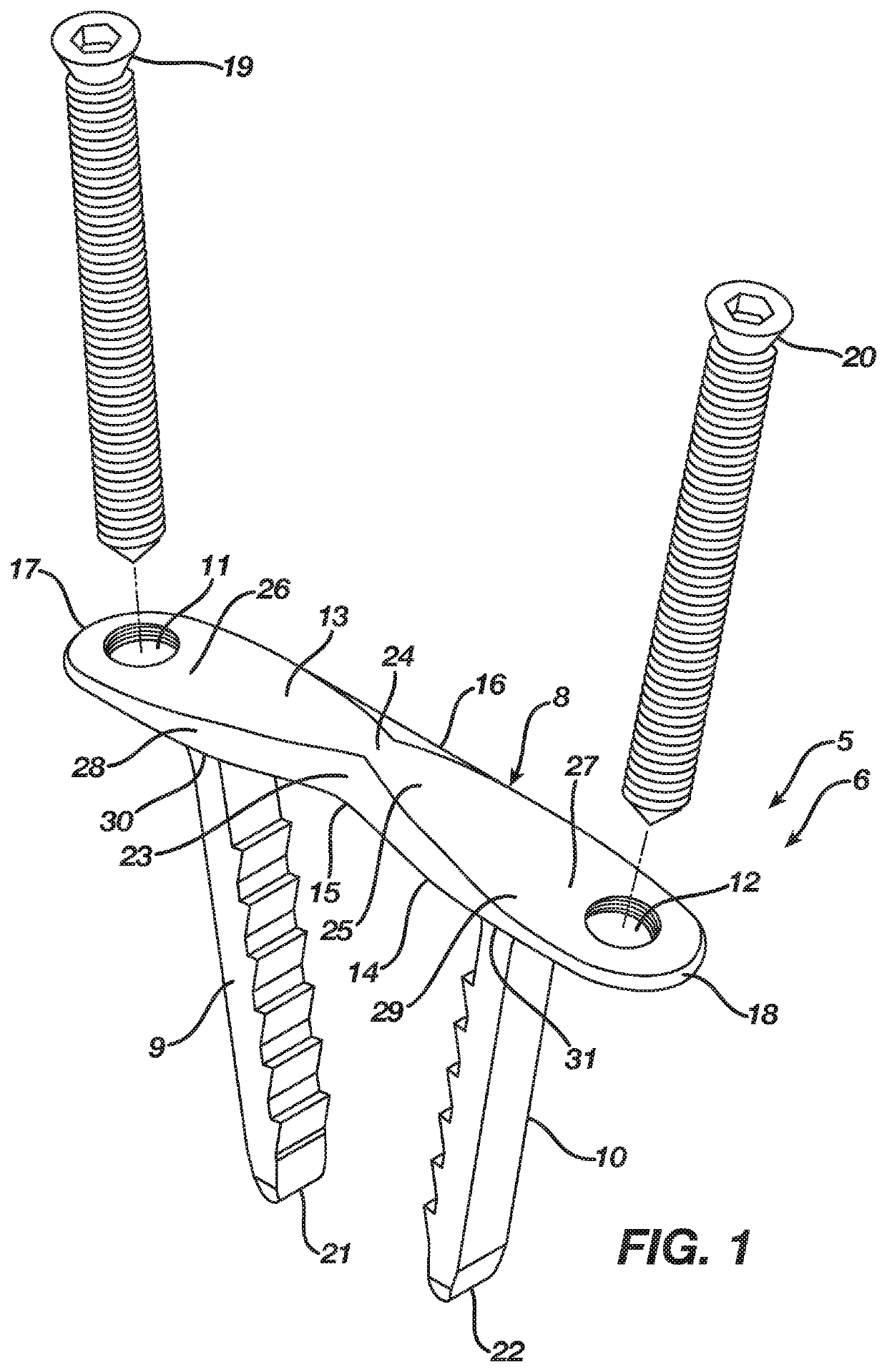 Method and apparatus for a continuous compression implant