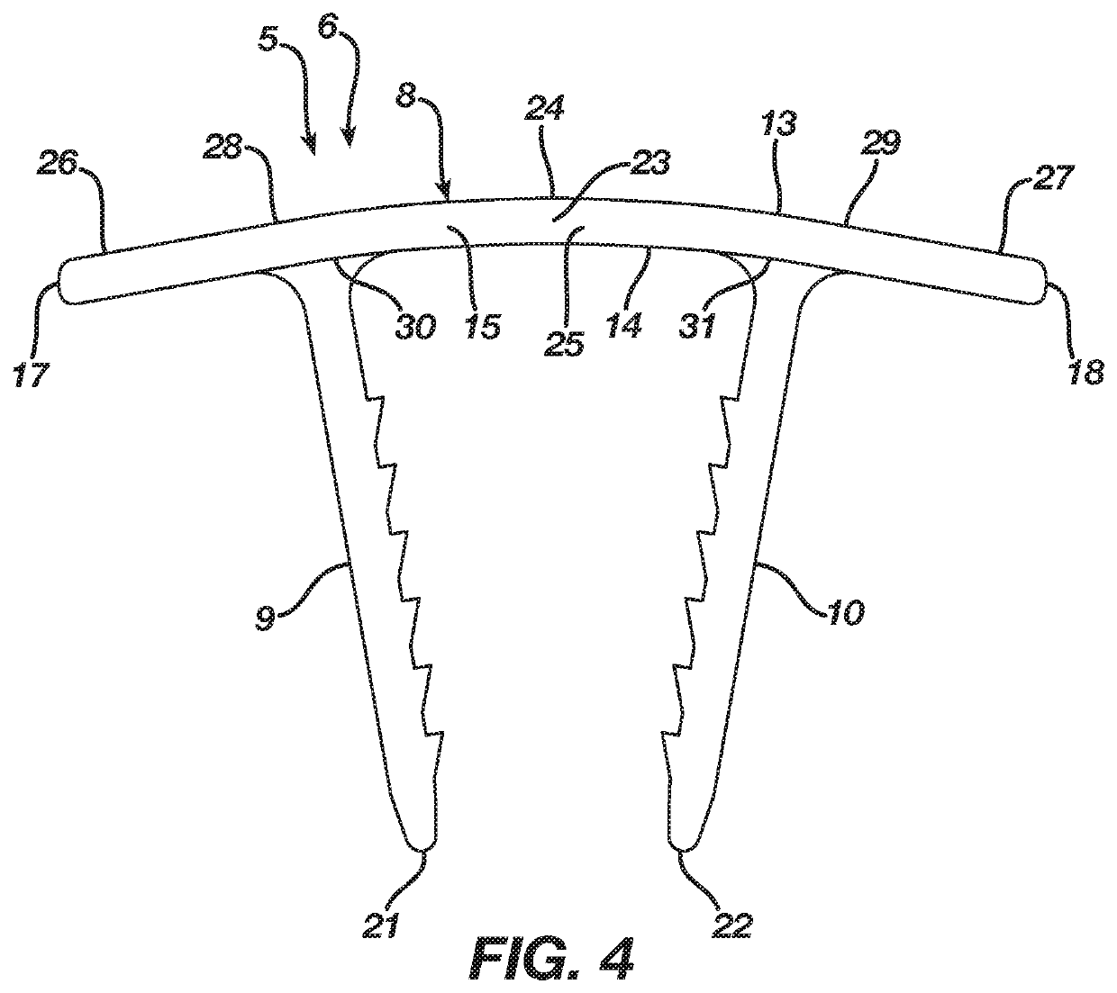 Method and apparatus for a continuous compression implant