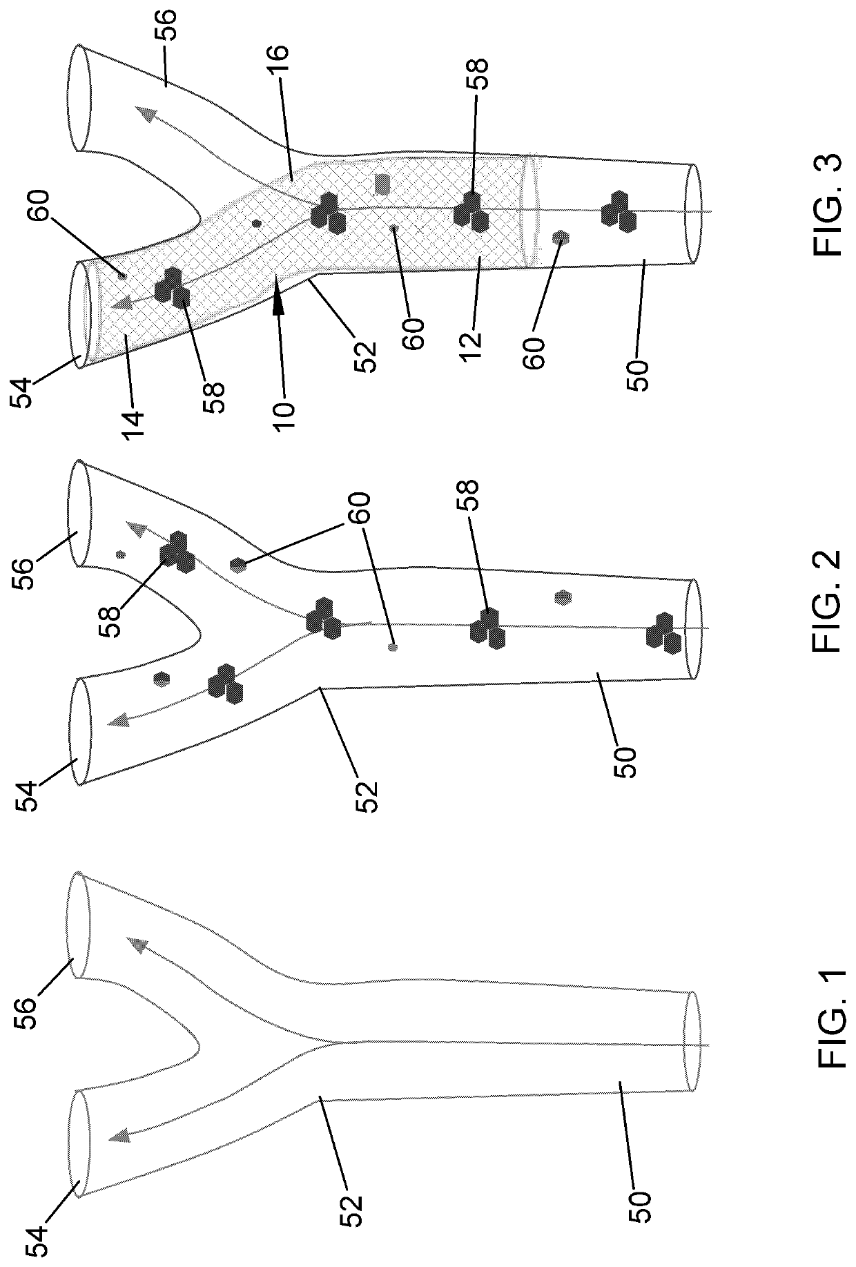 Thromboembolic protective flow-diverting, common carotid to external carotid intravascular stent