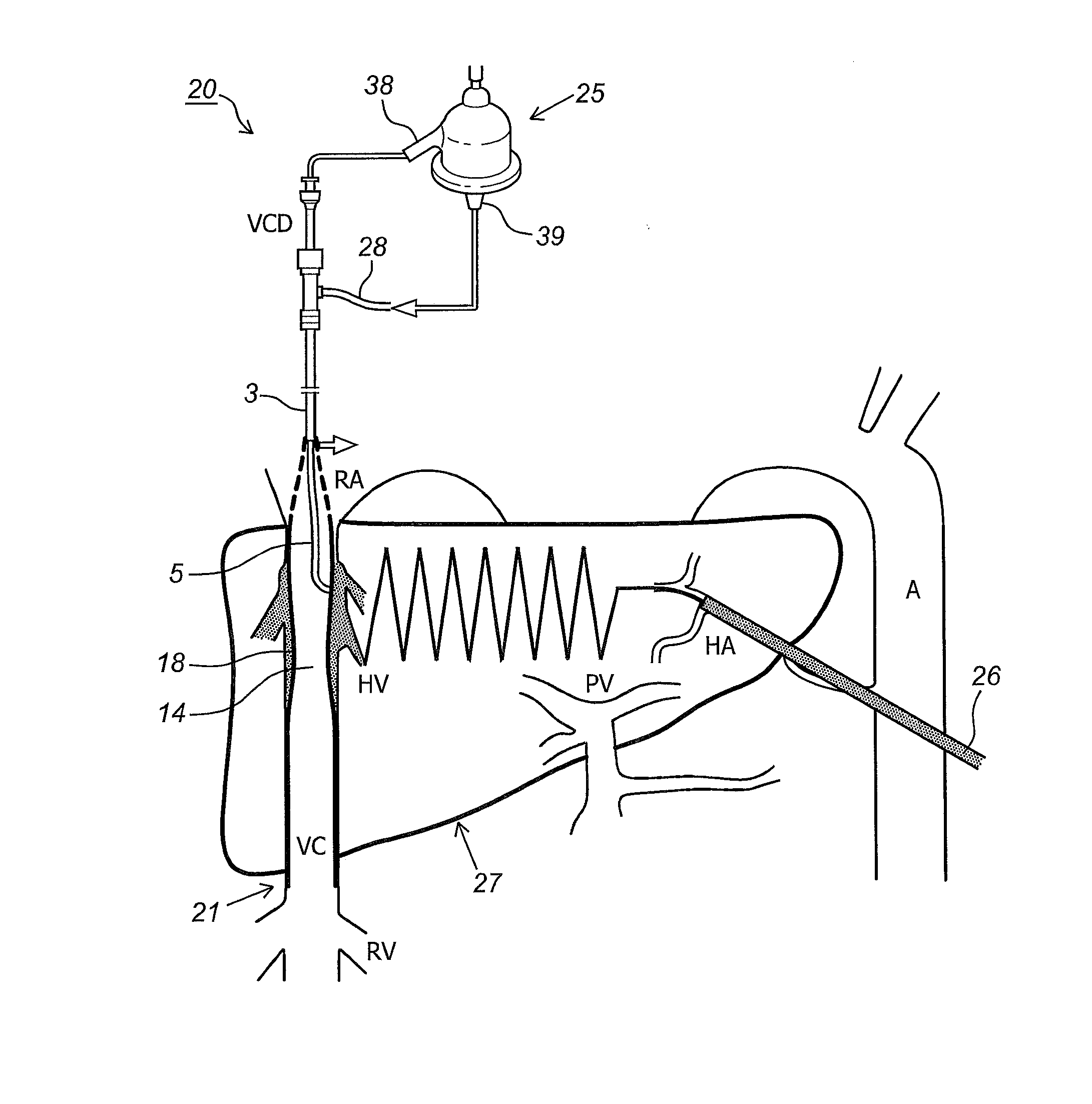 Kit and devices for organ perfusion