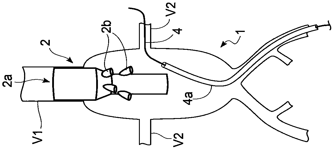 Treatment device for aneurysms preferably of aortic kind