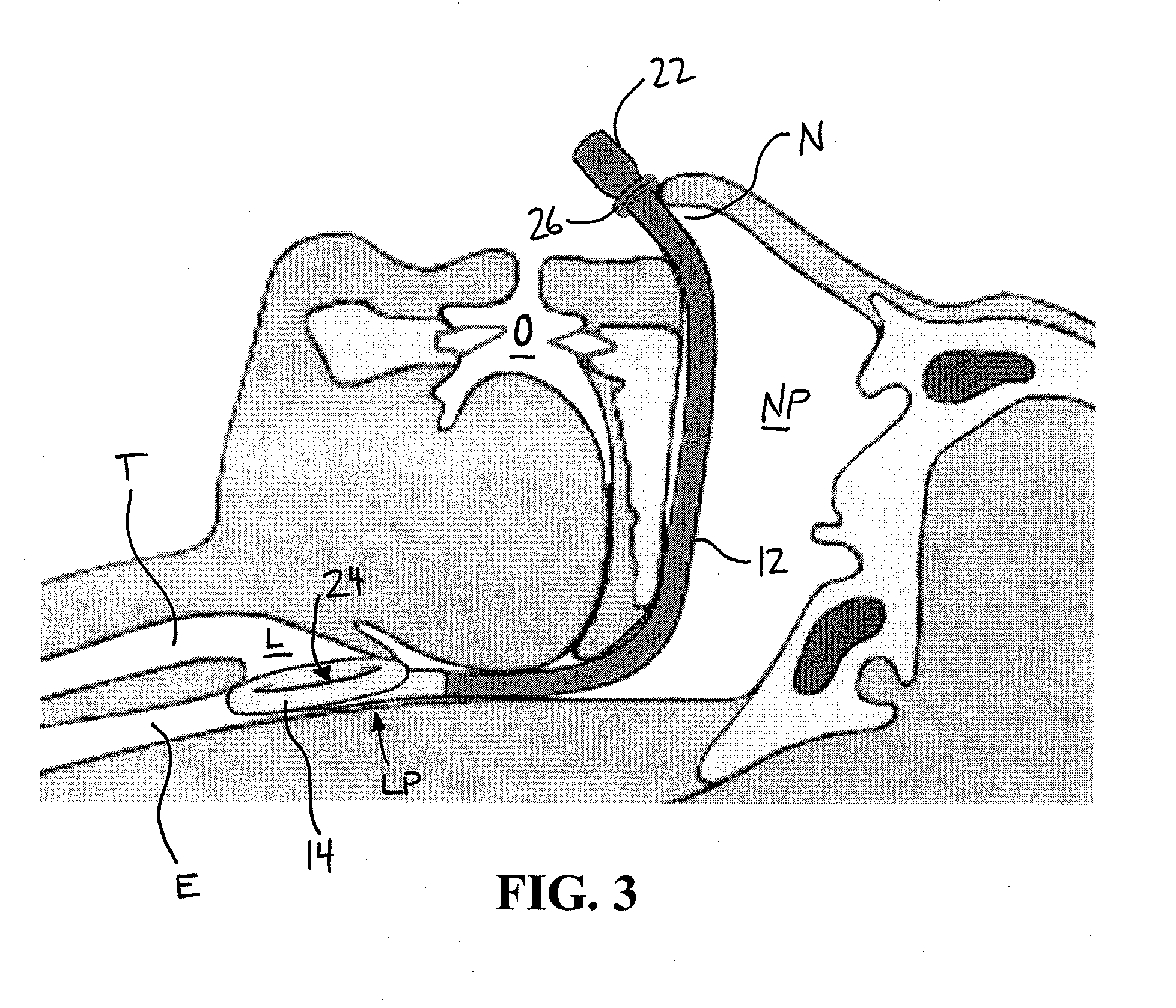 Nasal airway management device with inflatable supraglottic laryngeal cuff