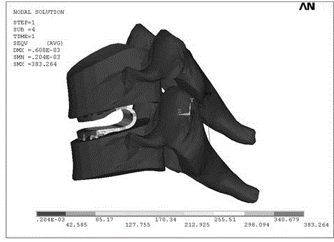 An integrated artificial cervical intervertebral disc prosthesis with high mobility