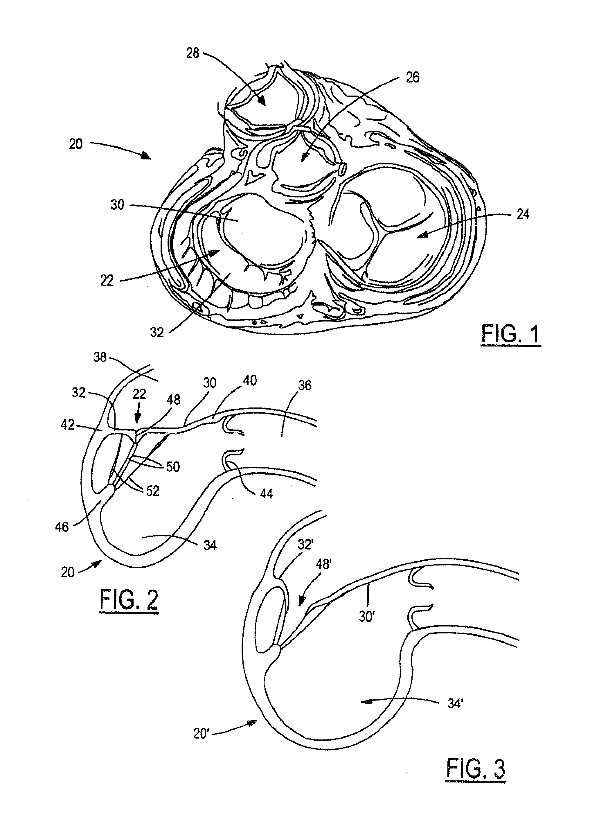 Method and system for treatment of regurgitating heart valves