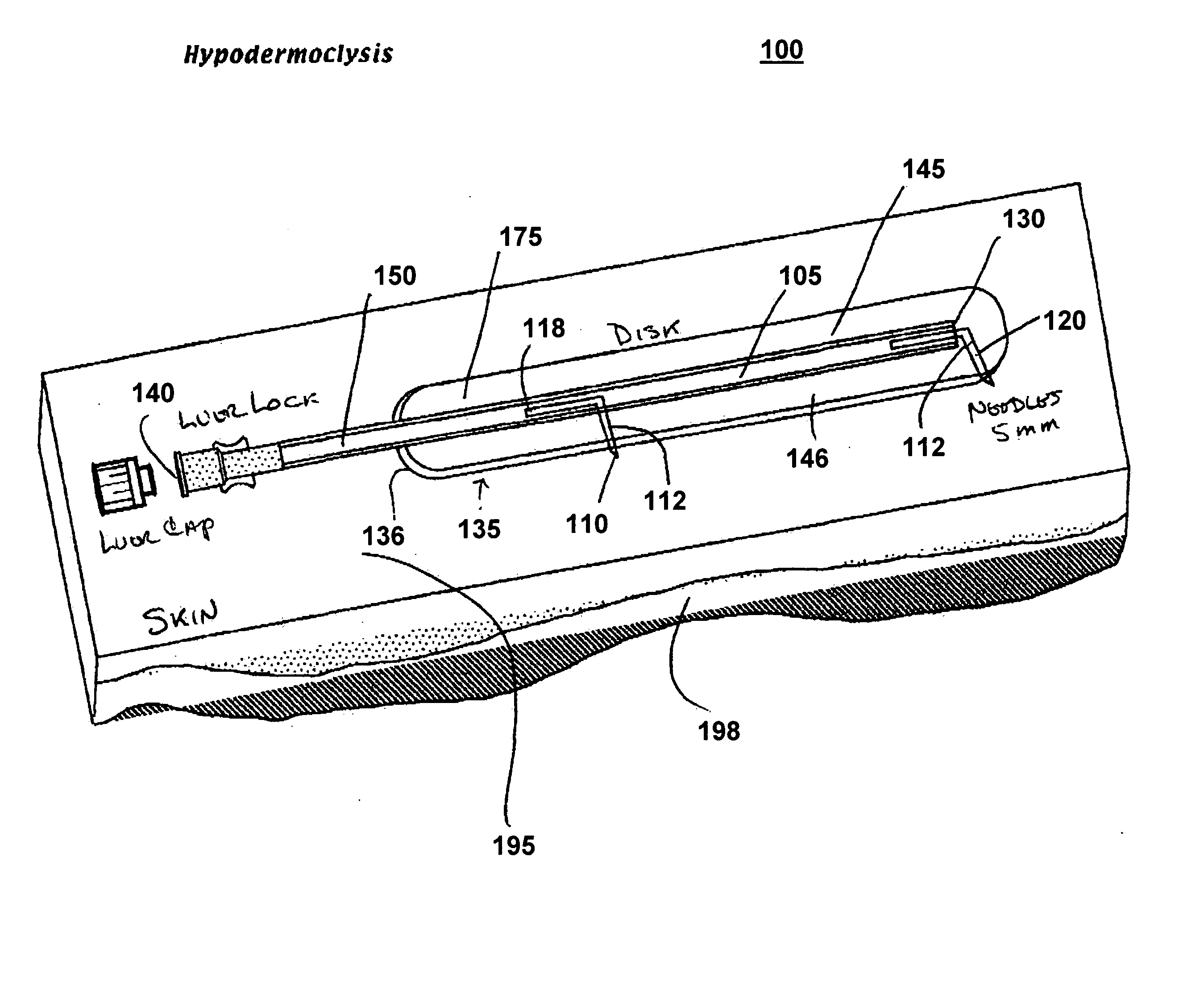 Device for subcutaneous infusion of fluids