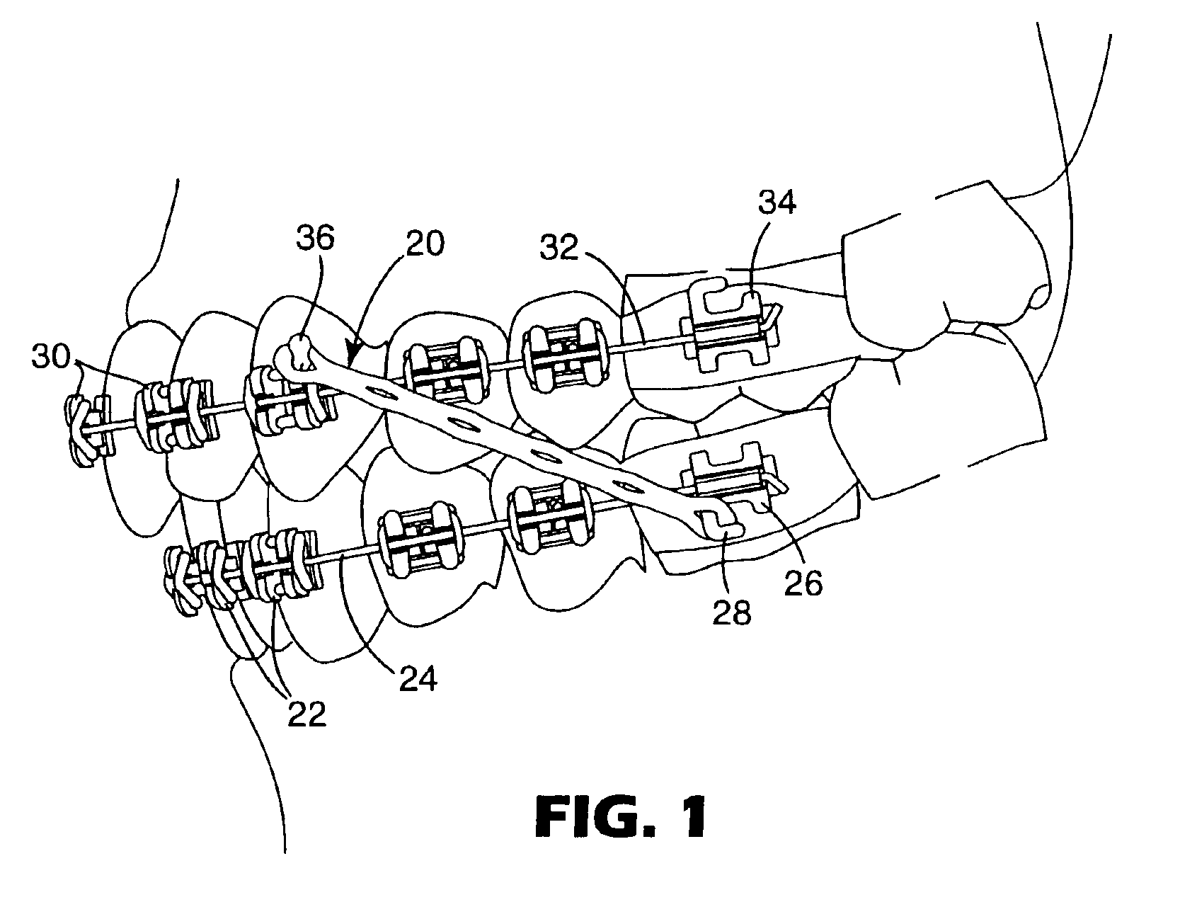 Elastomeric force module for orthodontic treatment