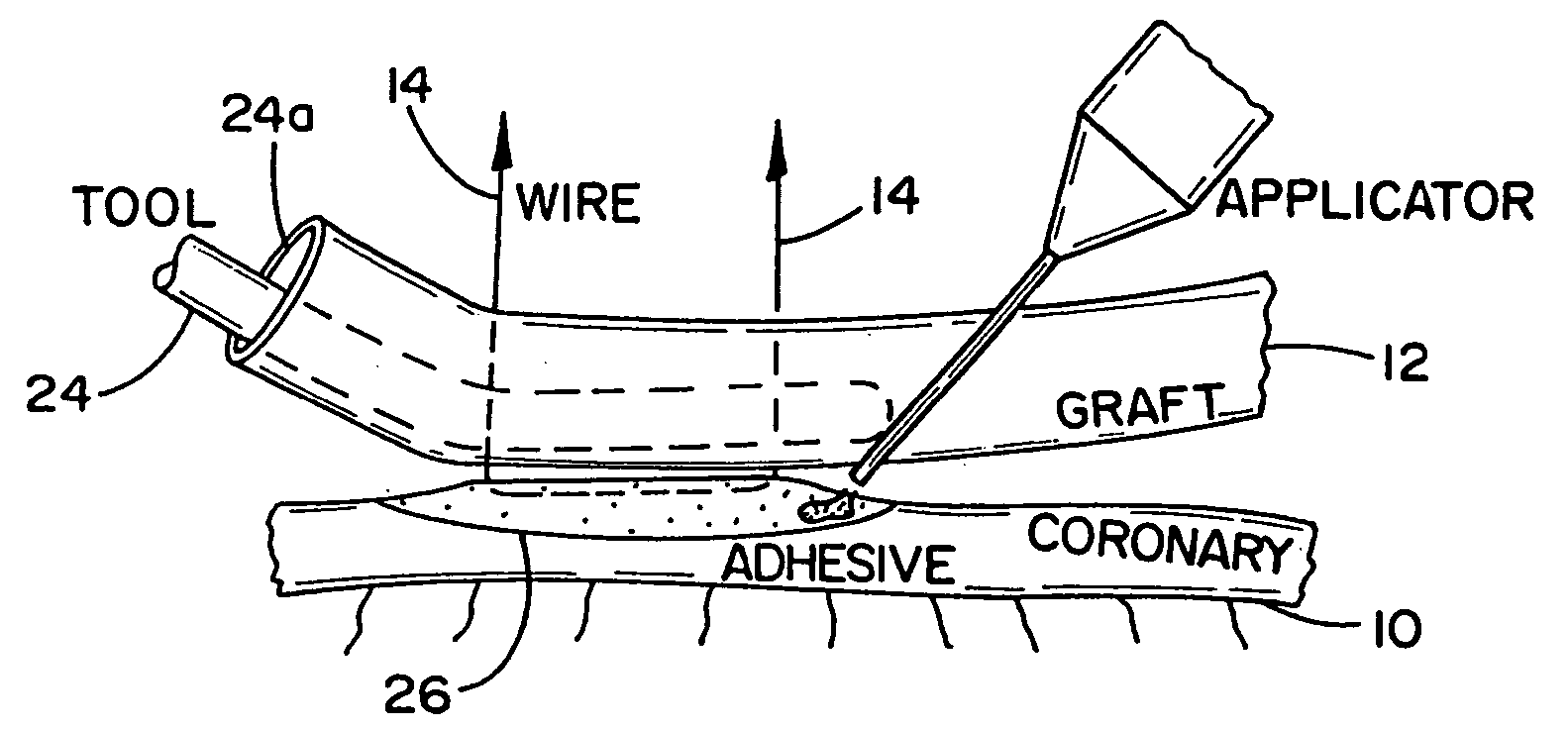 Arrangement and method for vascular anastomosis