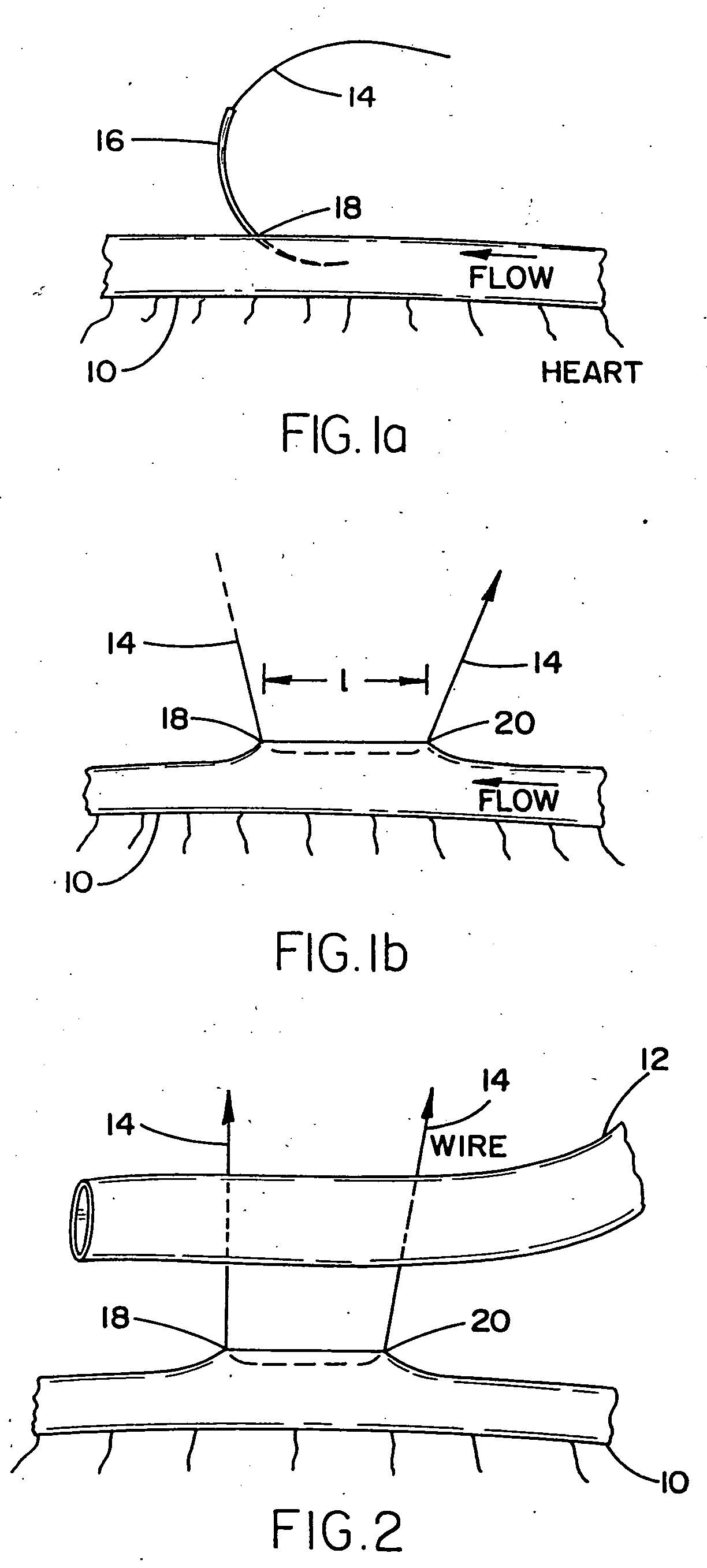 Arrangement and method for vascular anastomosis