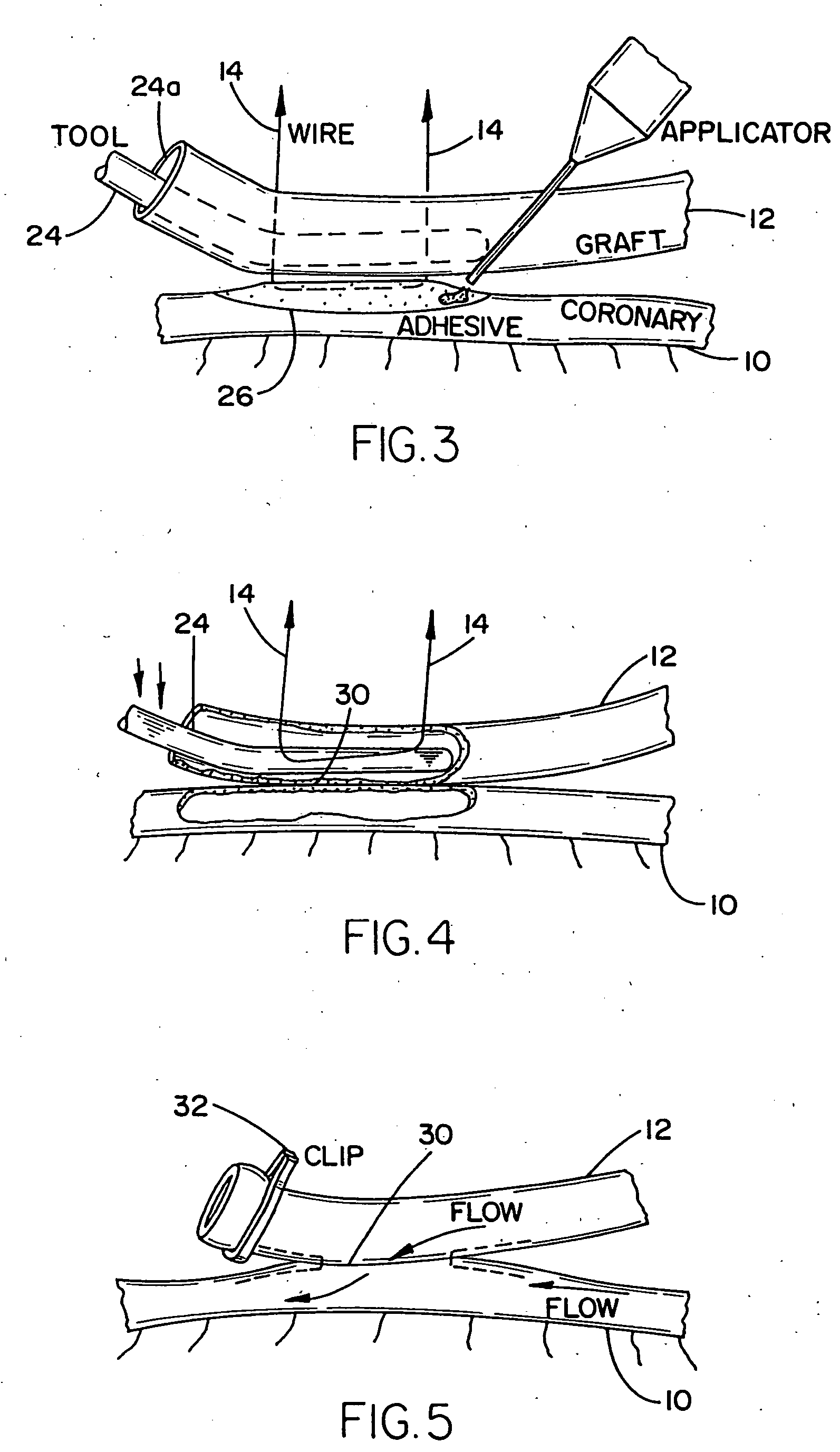 Arrangement and method for vascular anastomosis