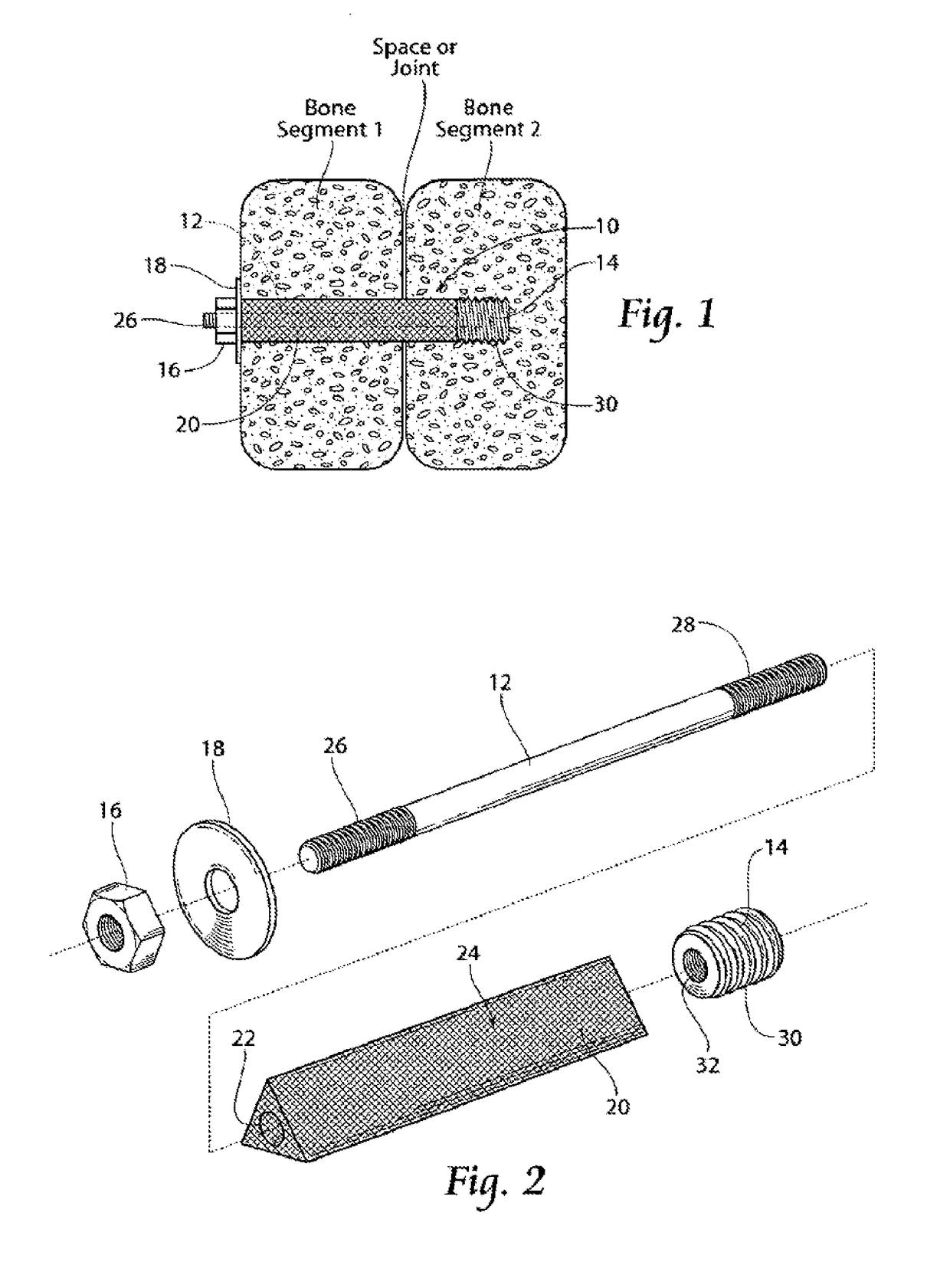 Apparatus, systems, and methods for the fixation or fusion of bone