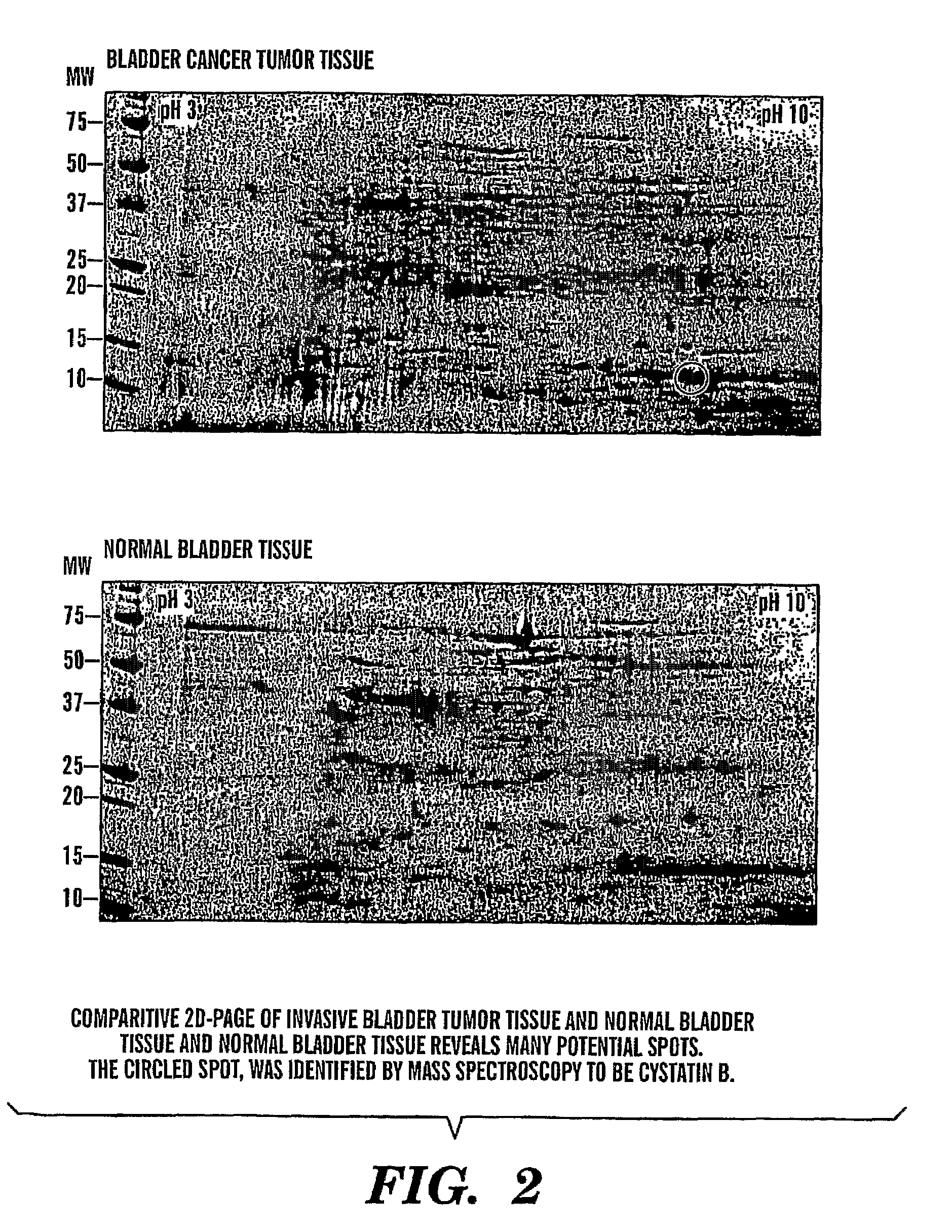 Method for diagnosis and prognosis of epithelial cancers