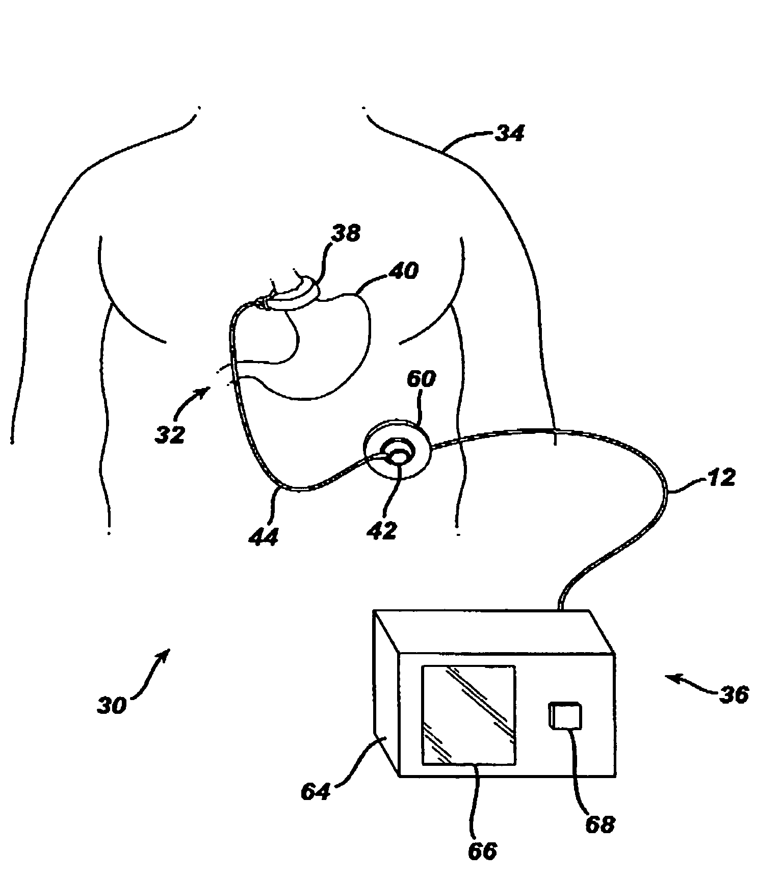 Non-invasive measurement of fluid pressure in an adjustable gastric band