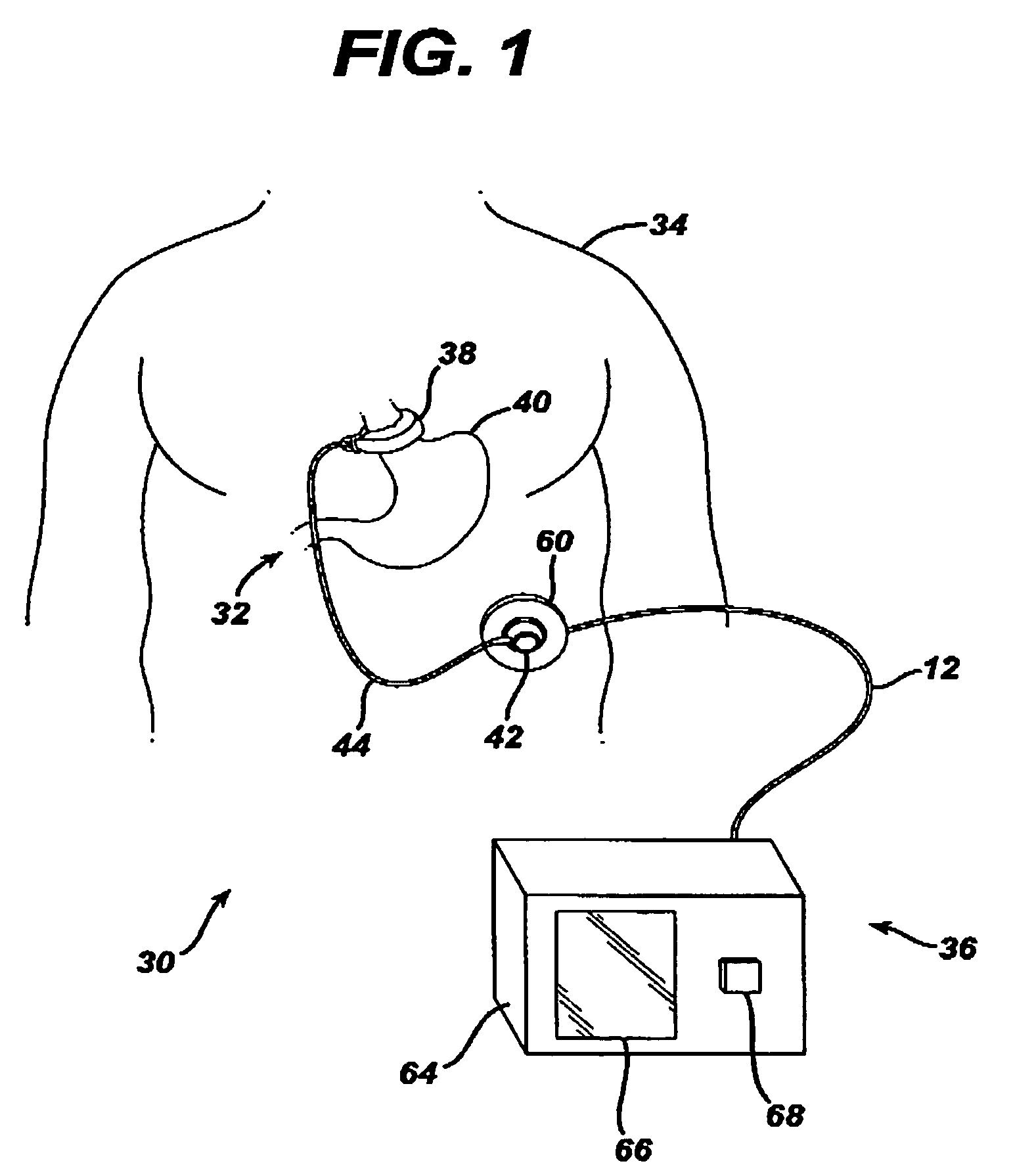 Non-invasive measurement of fluid pressure in an adjustable gastric band