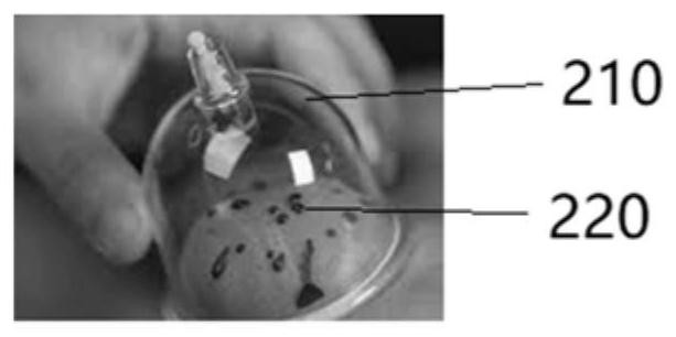 Bloodletting needle, bloodletting needle system and bloodletting method