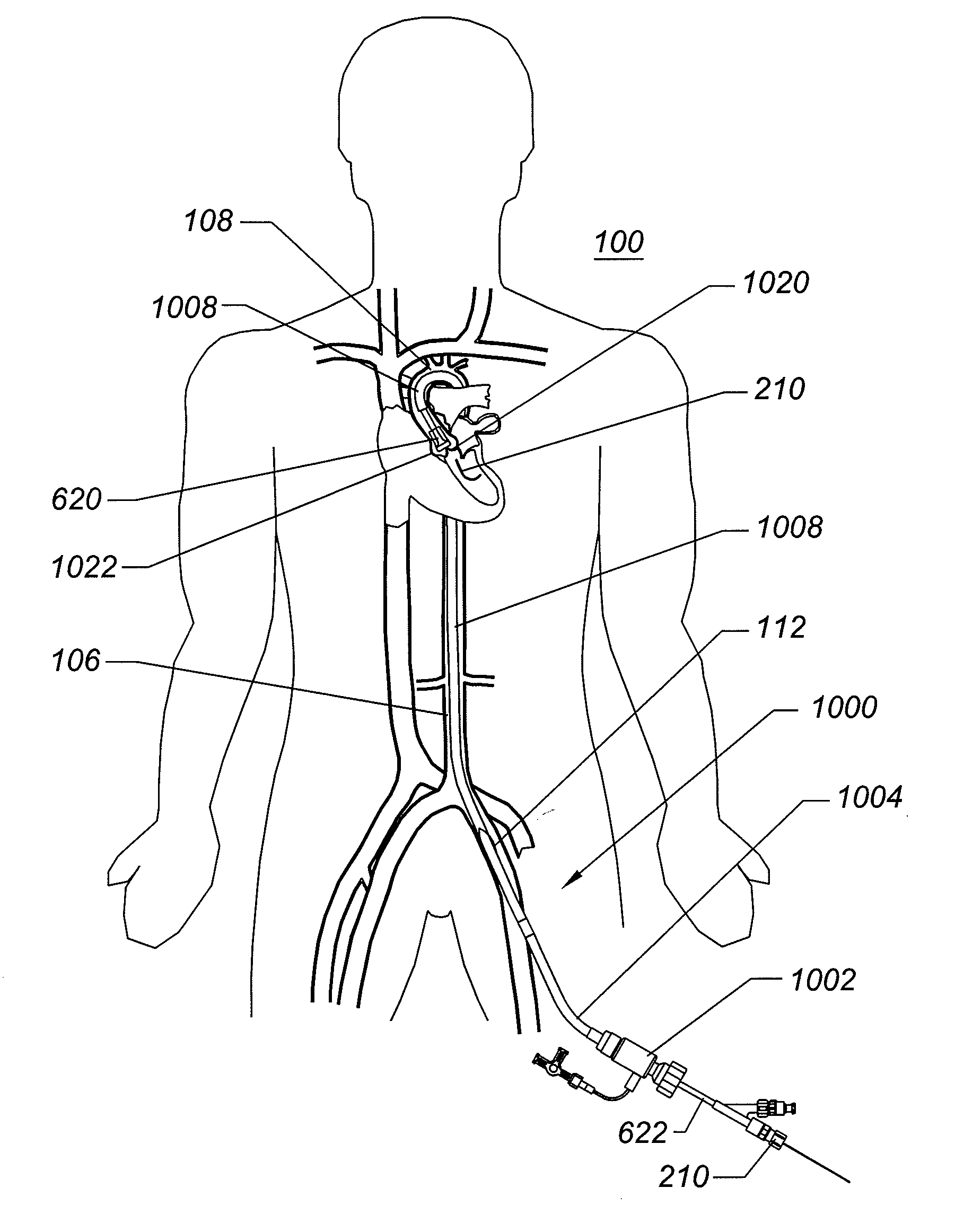 Expandable iliac sheath and method of use