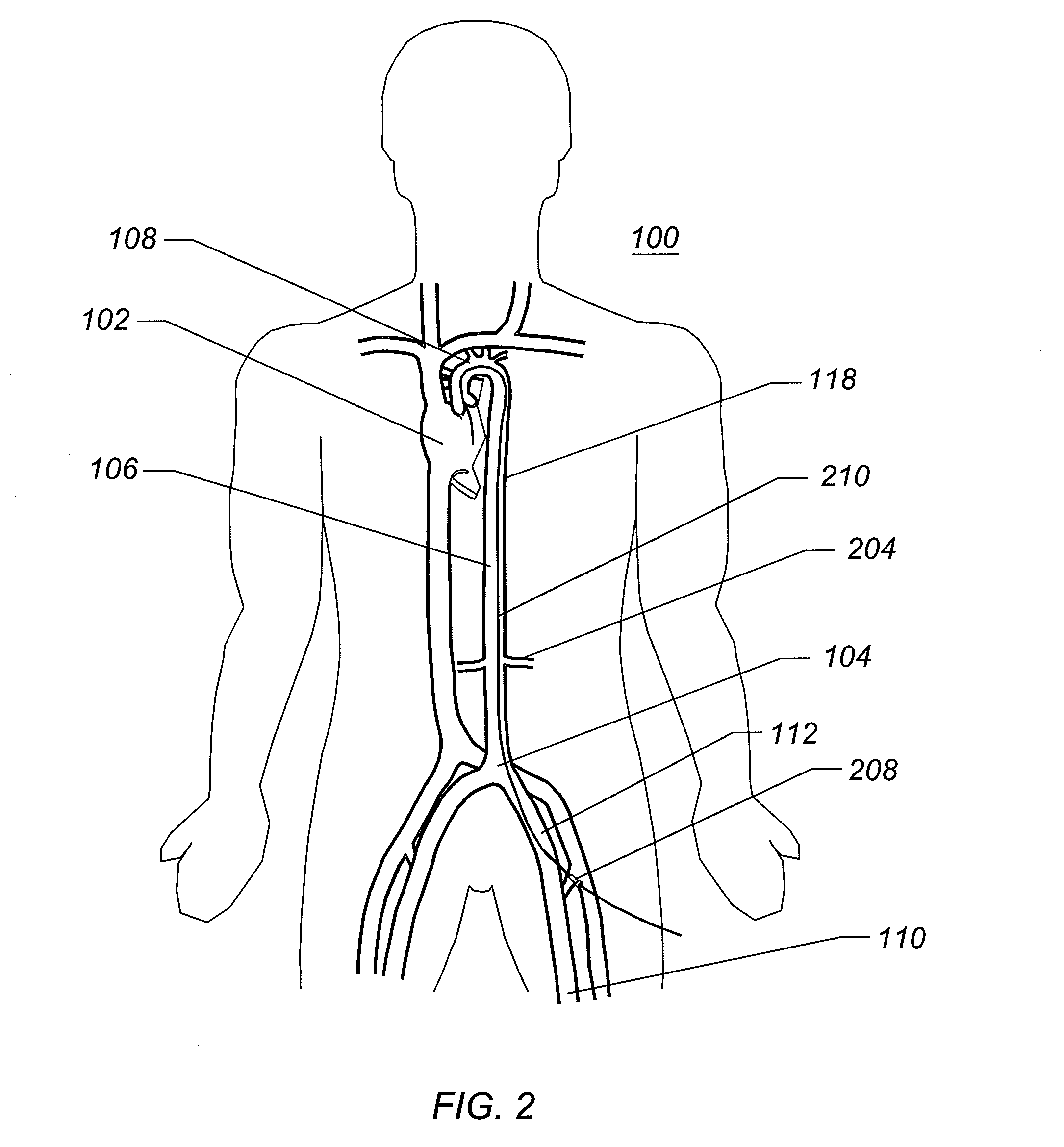 Expandable iliac sheath and method of use