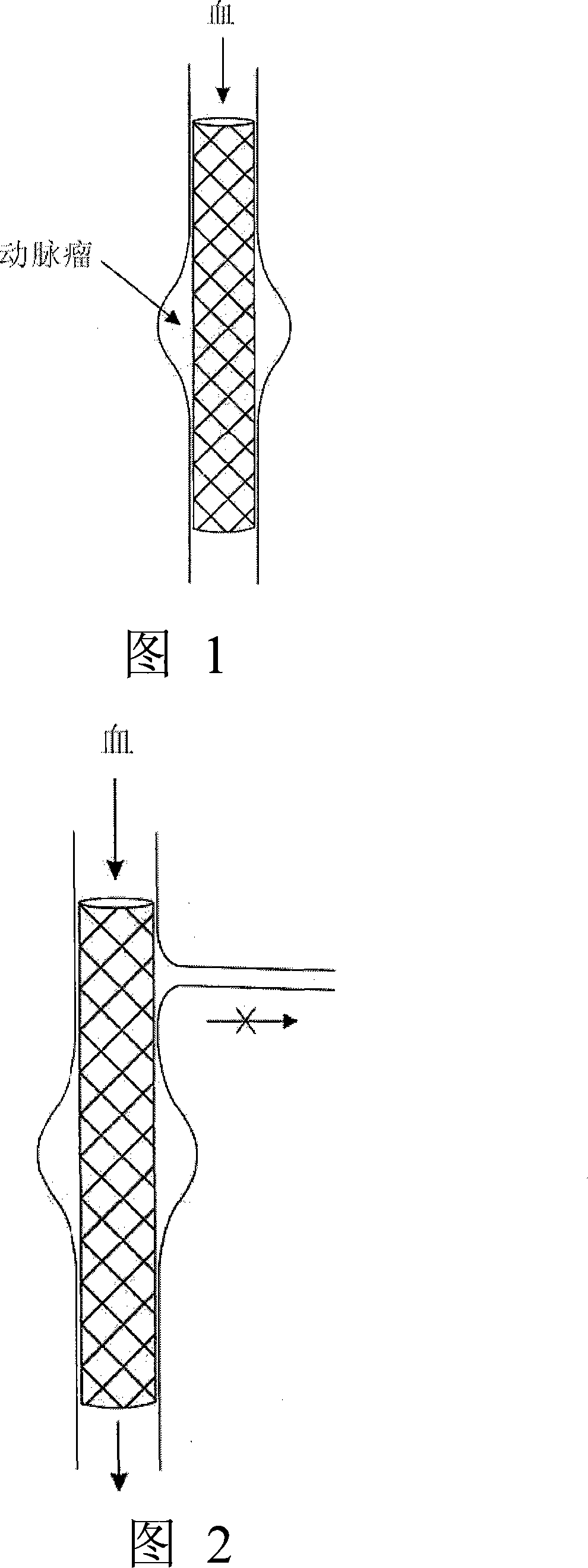 Modular stent graft and delivery system