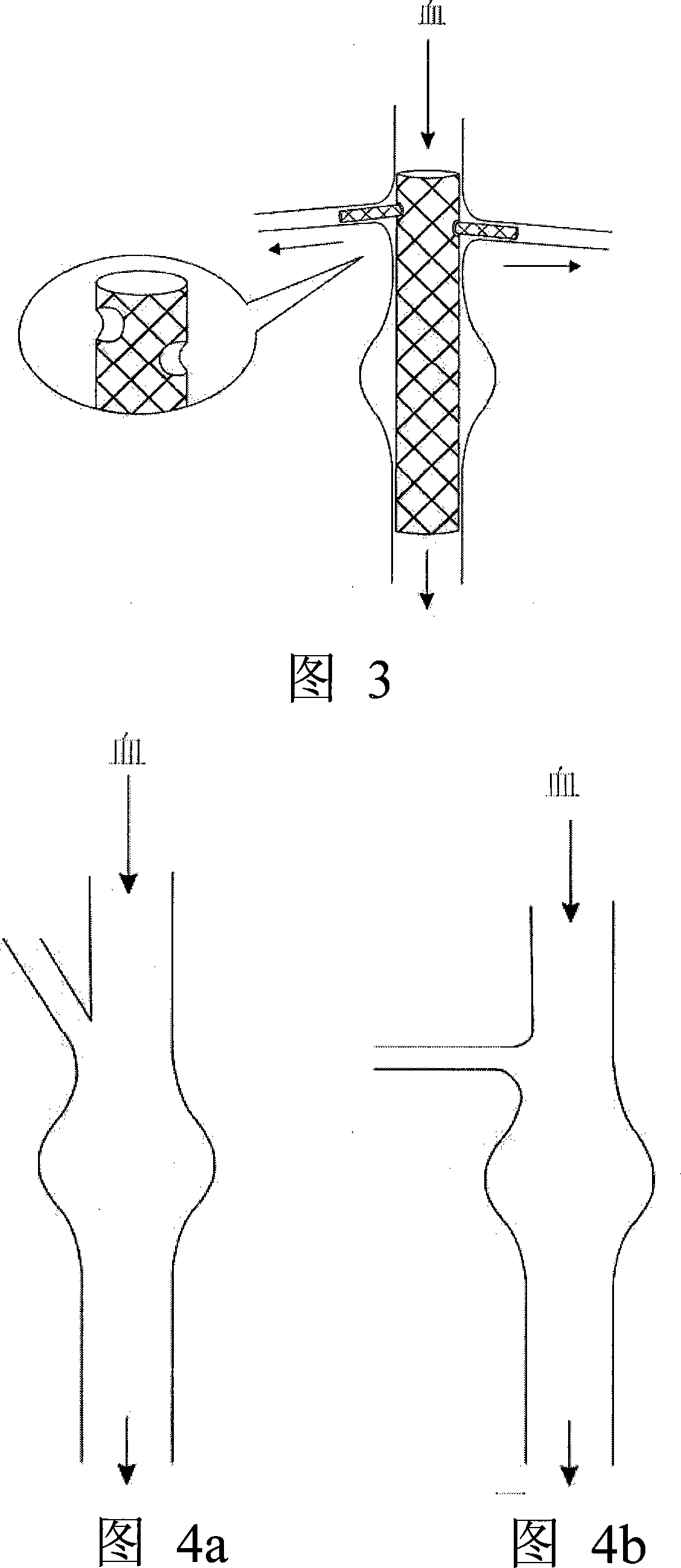 Modular stent graft and delivery system