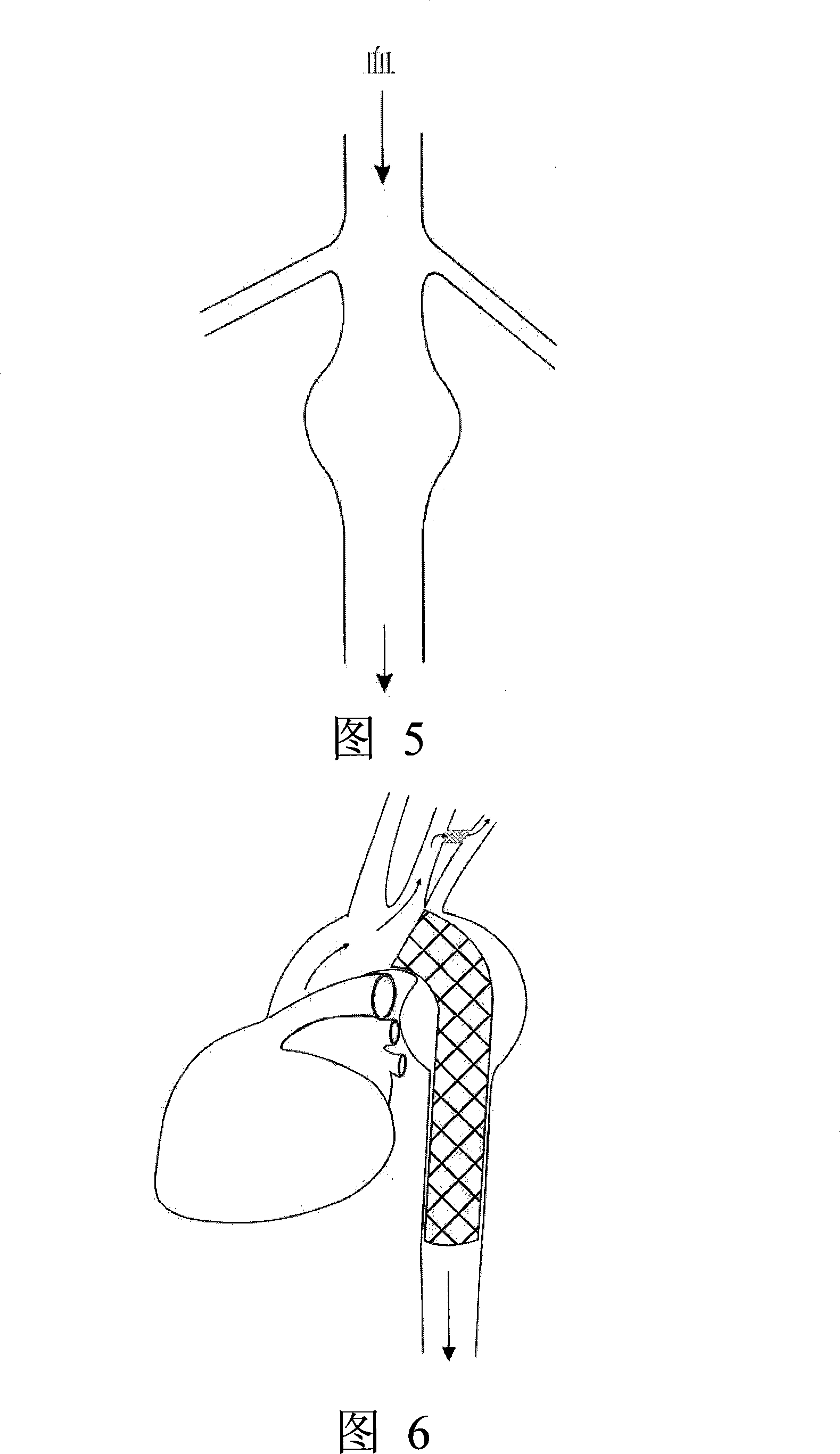 Modular stent graft and delivery system