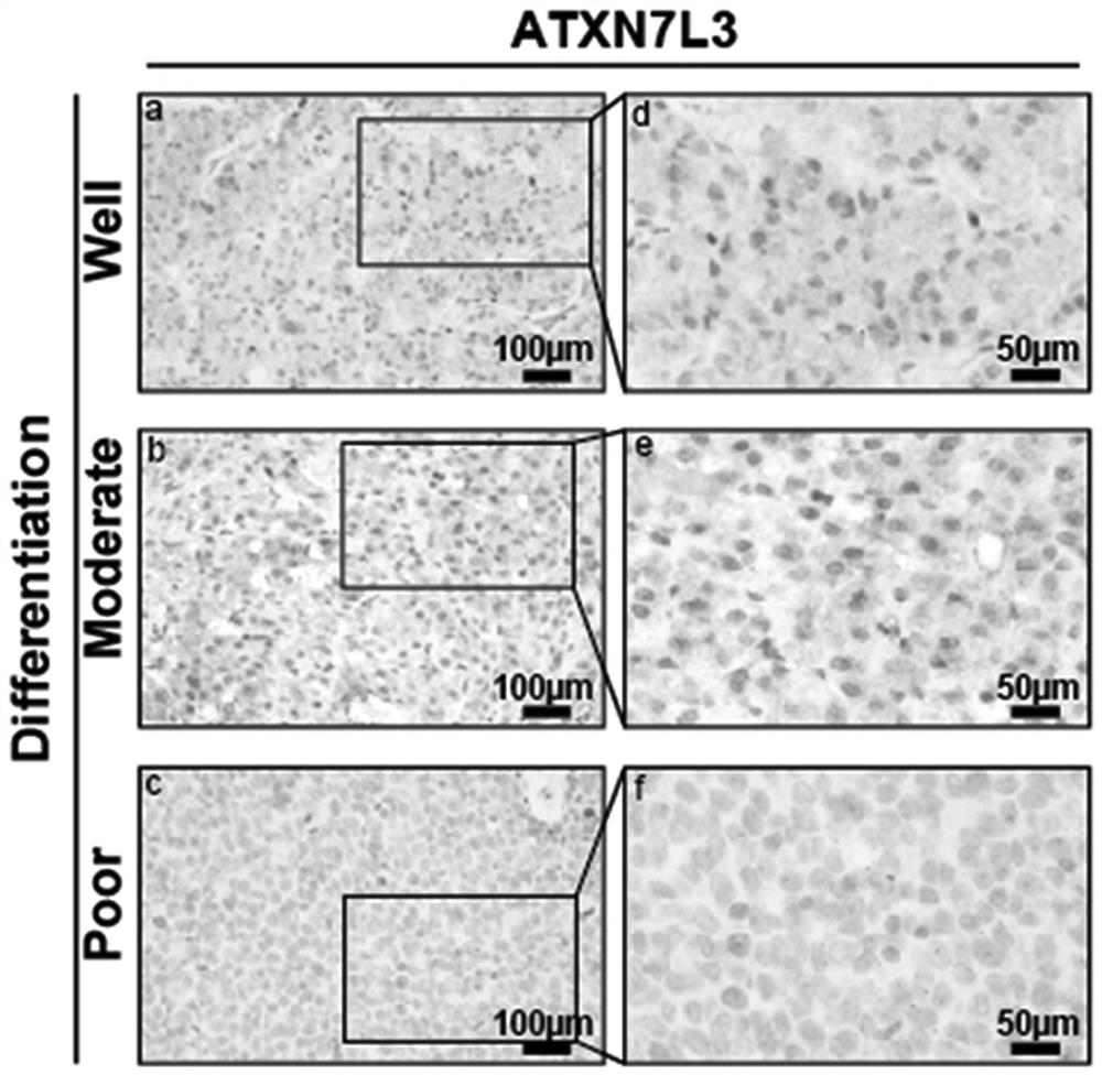 Application of ATXN7L3 in liver cancer diagnosis, treatment and prognosis