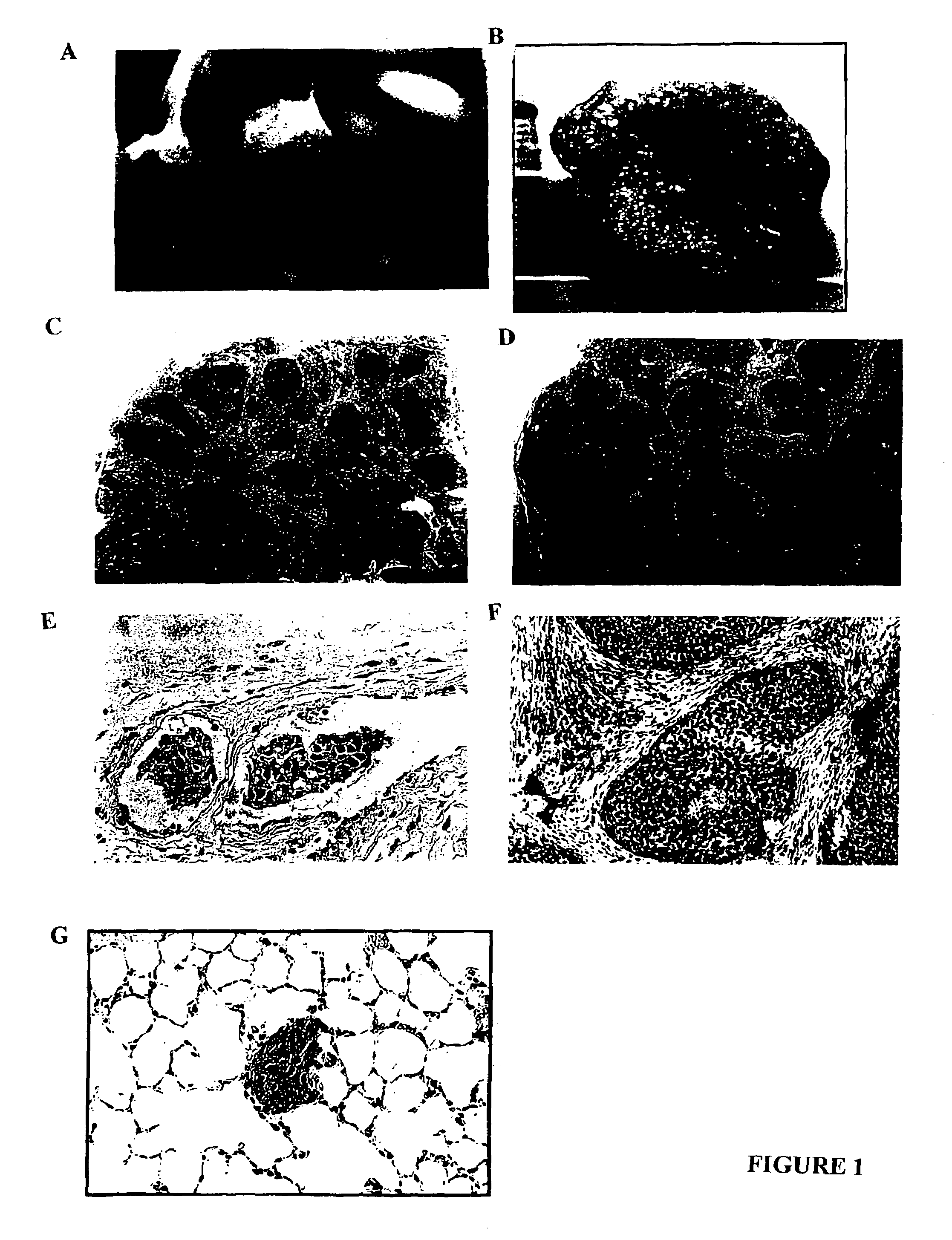 Human inflammatory breast carcinoma xenograft capable of lymphovascular invasion and methods for its use