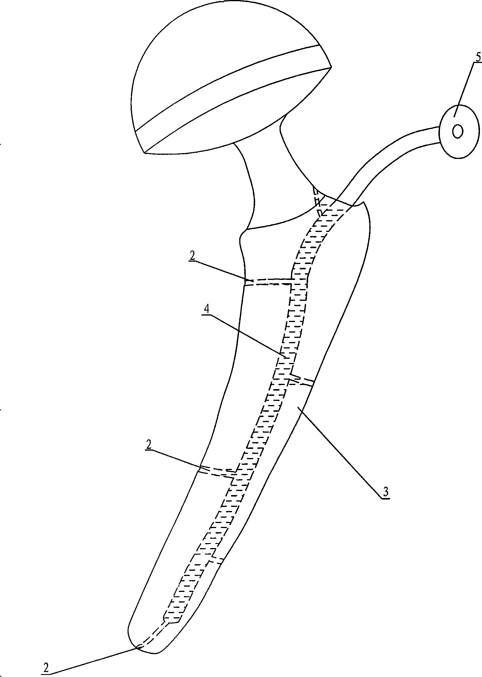 Antibiotic artificial hip joint