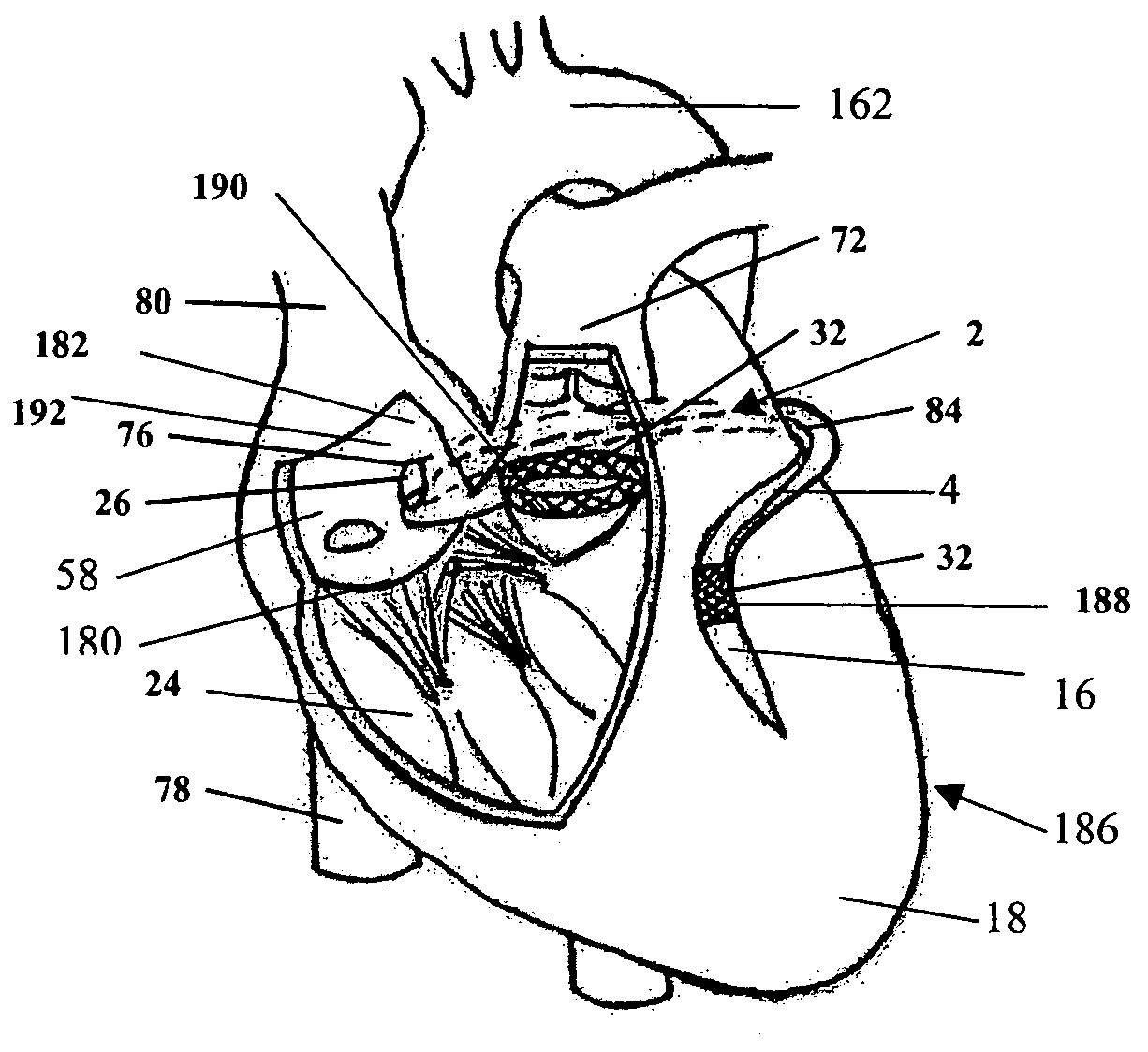 Systems for heart treatment