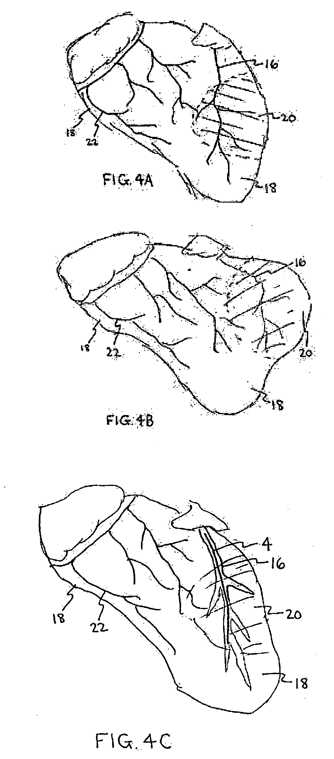 Systems for heart treatment