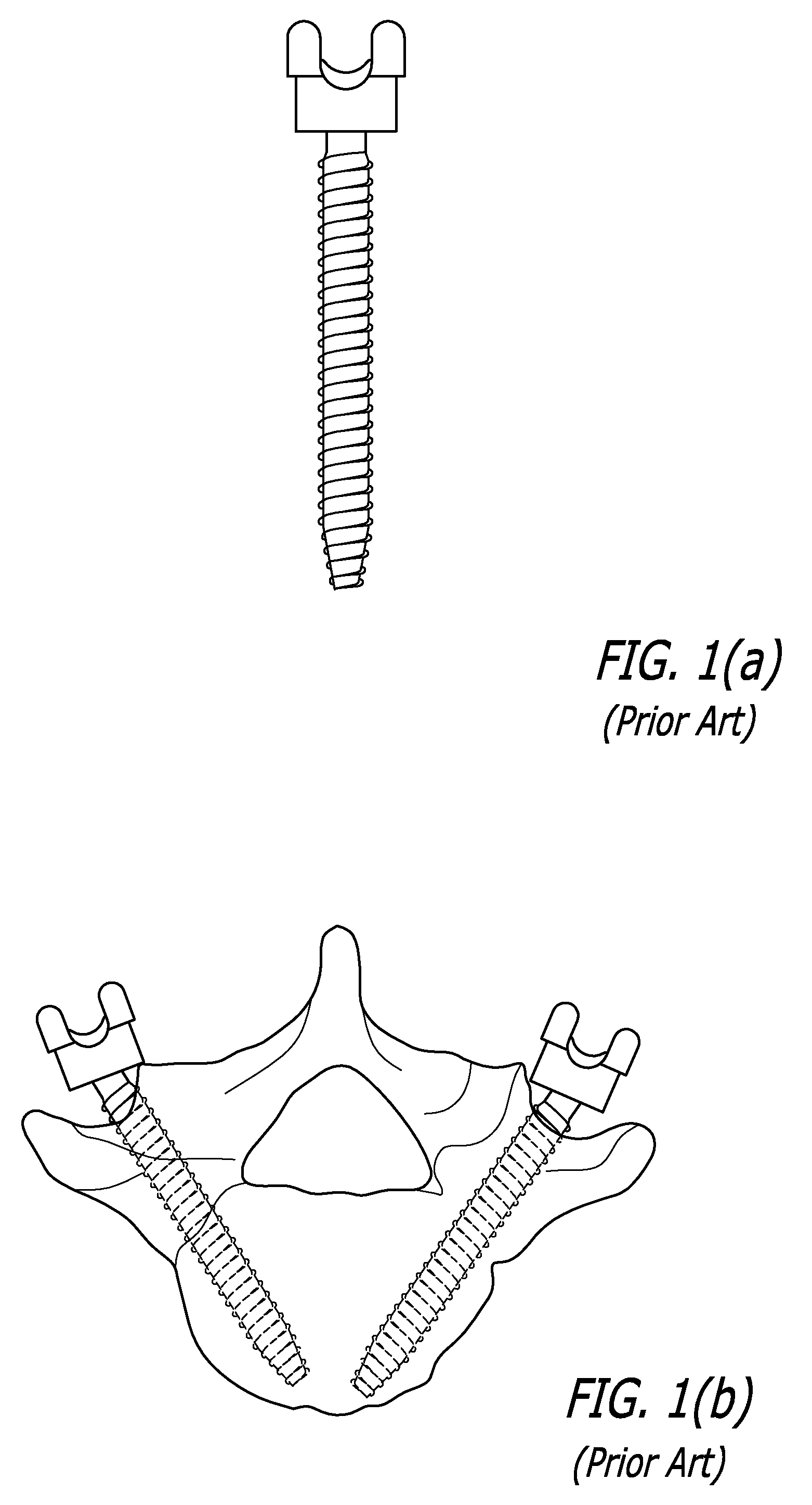 Acoustic Back-Scattering Sensing Screw for Preventing Spine Surgery Complications