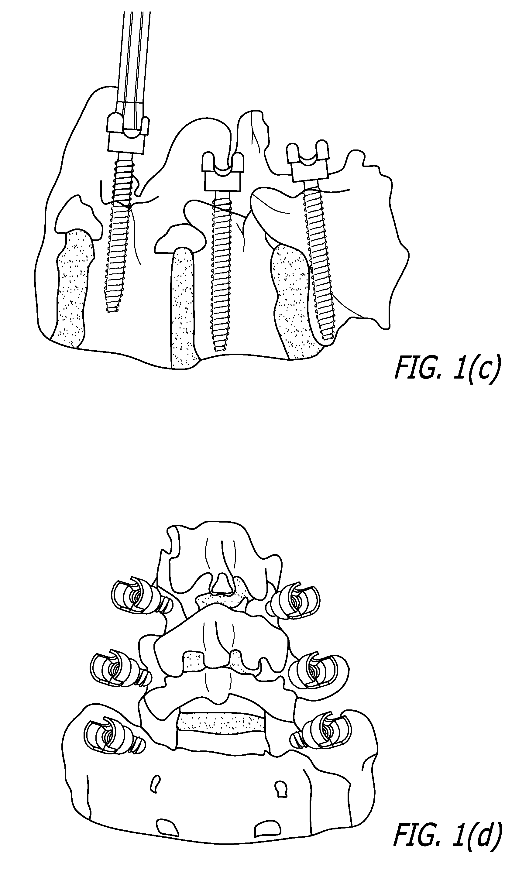 Acoustic Back-Scattering Sensing Screw for Preventing Spine Surgery Complications