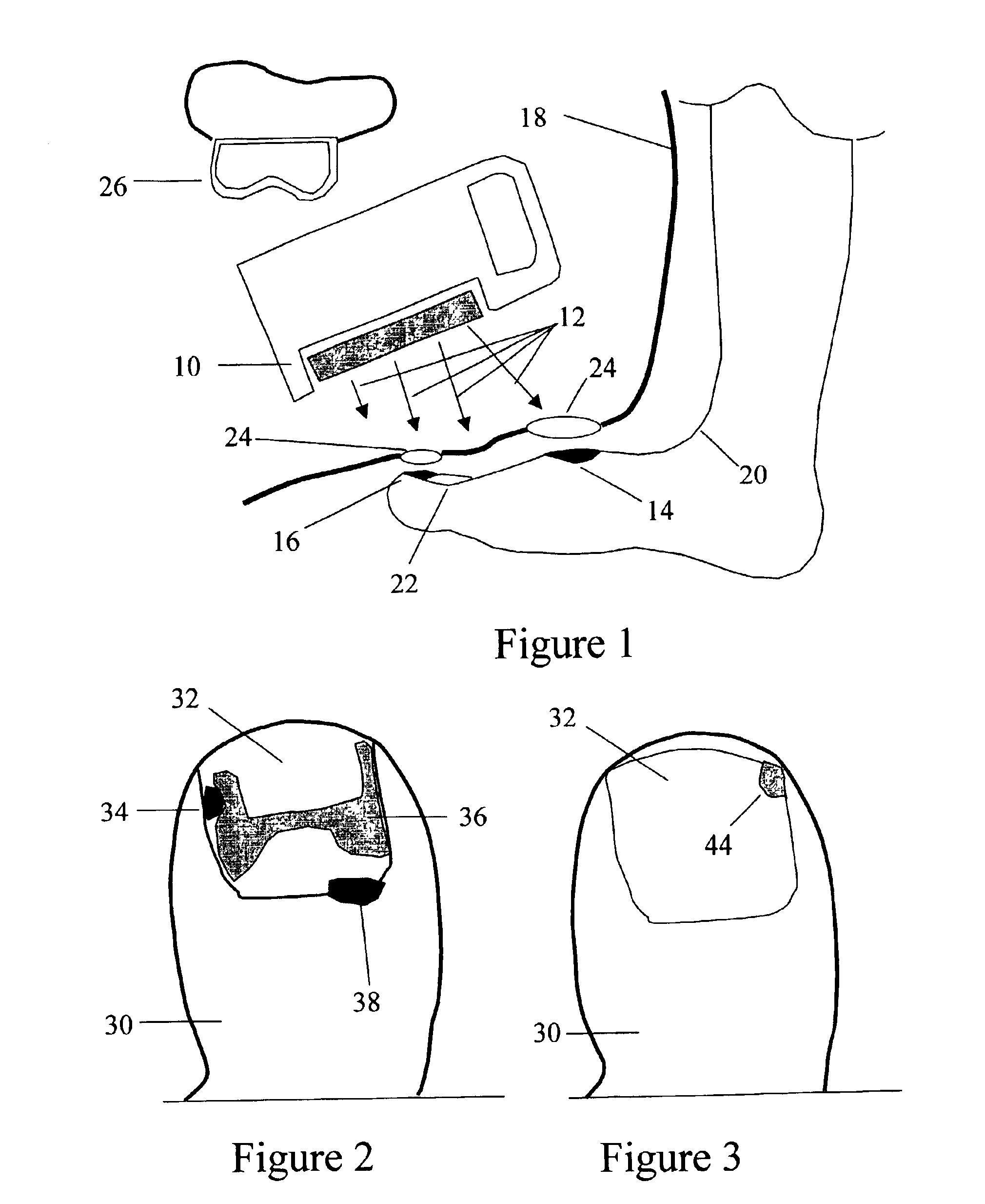 Method for the prevention and treatment of skin and nail infections