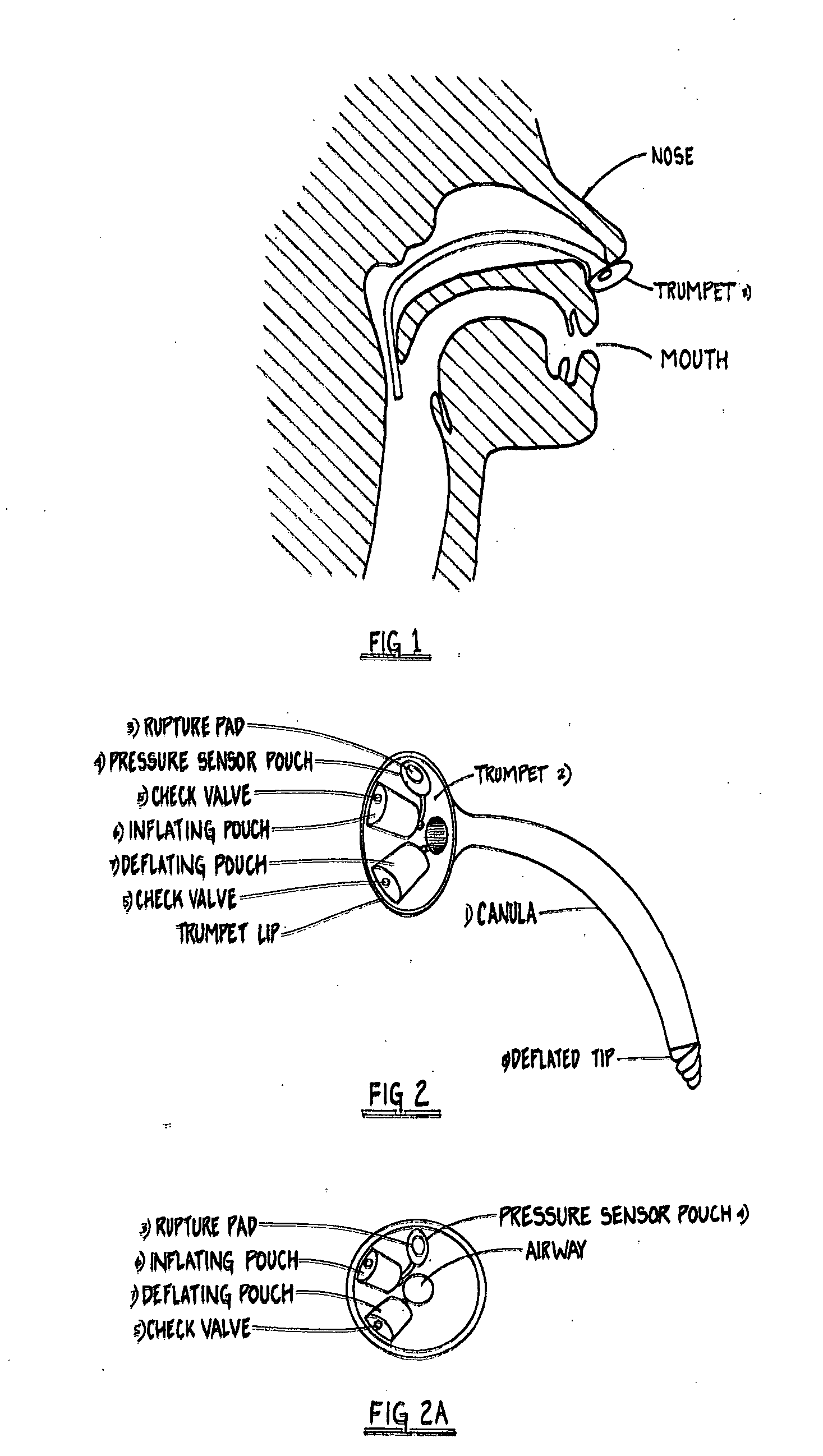 Nasopharyngeal Trumpet with Inflatable Tip