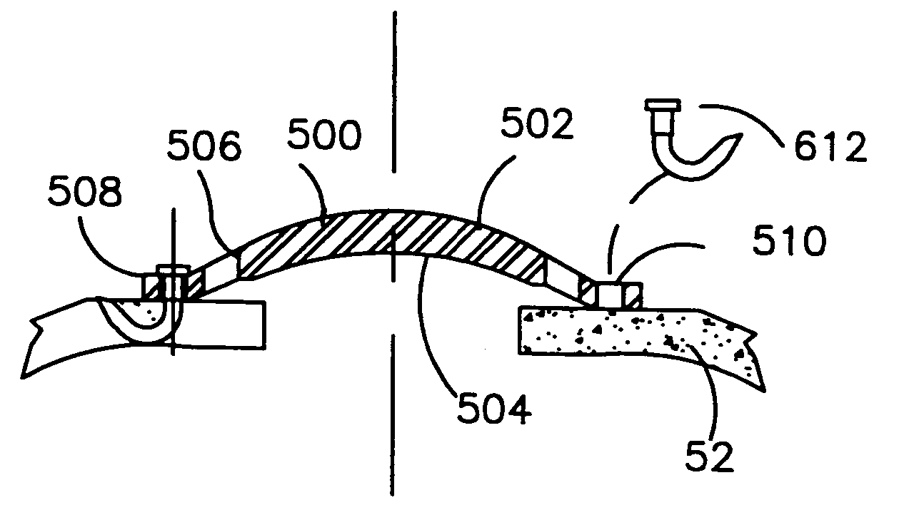 Refractive intraocular implant lens and method