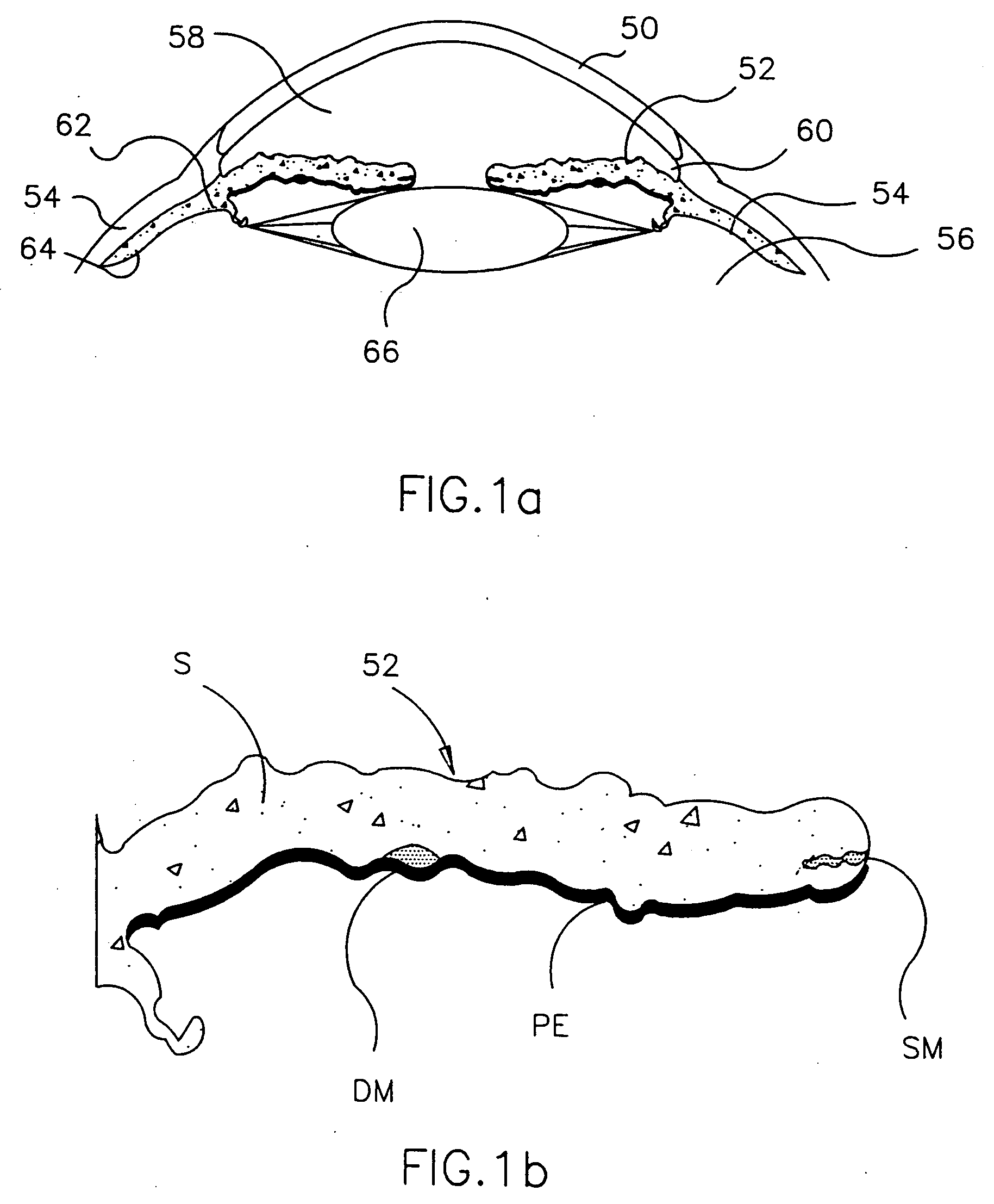 Refractive intraocular implant lens and method