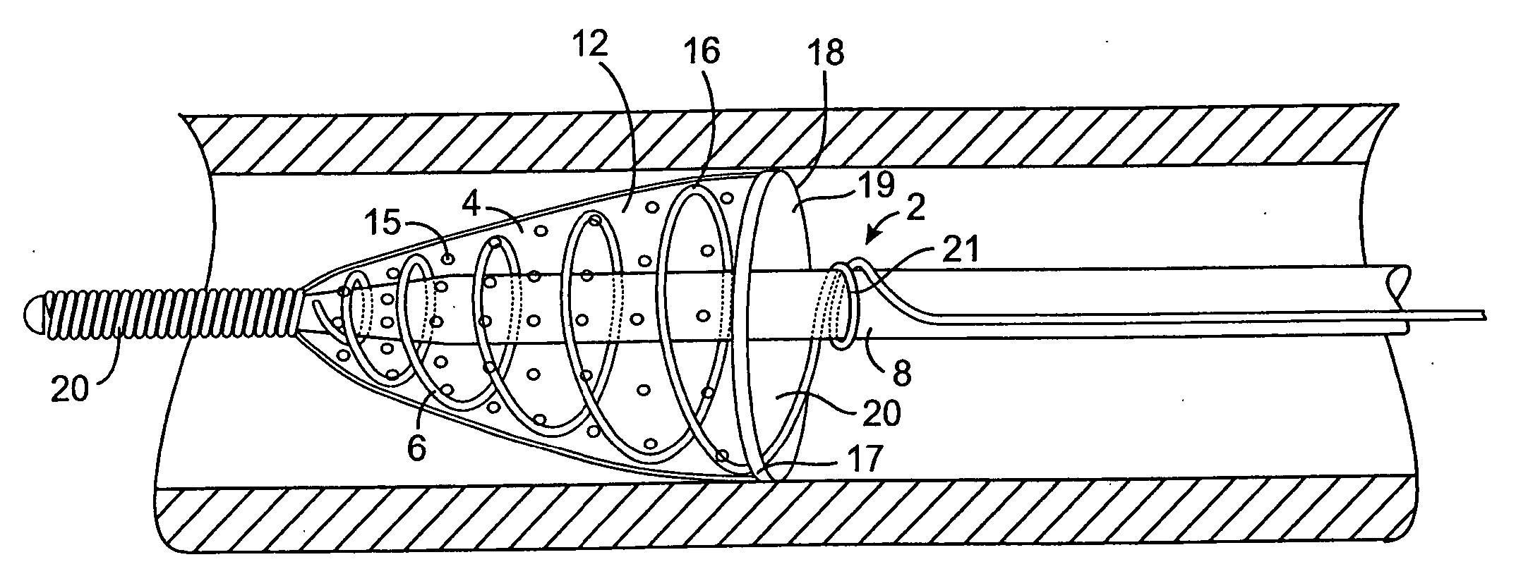 Methods and devices for filtering fluid flow through a body structure