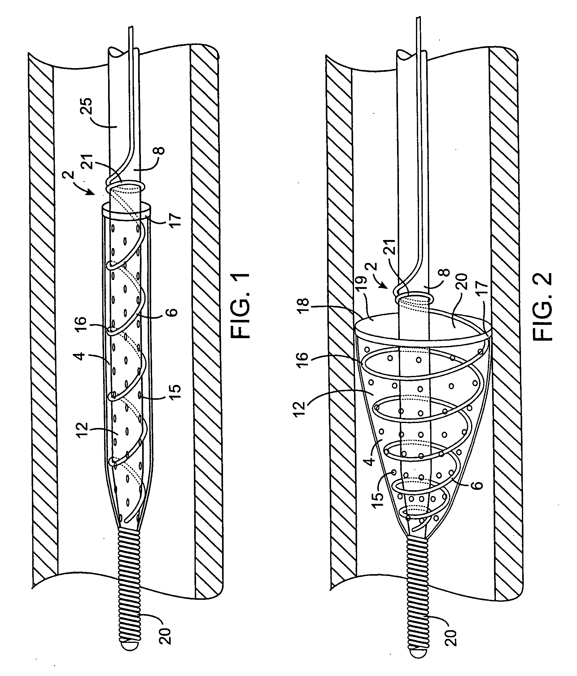 Methods and devices for filtering fluid flow through a body structure